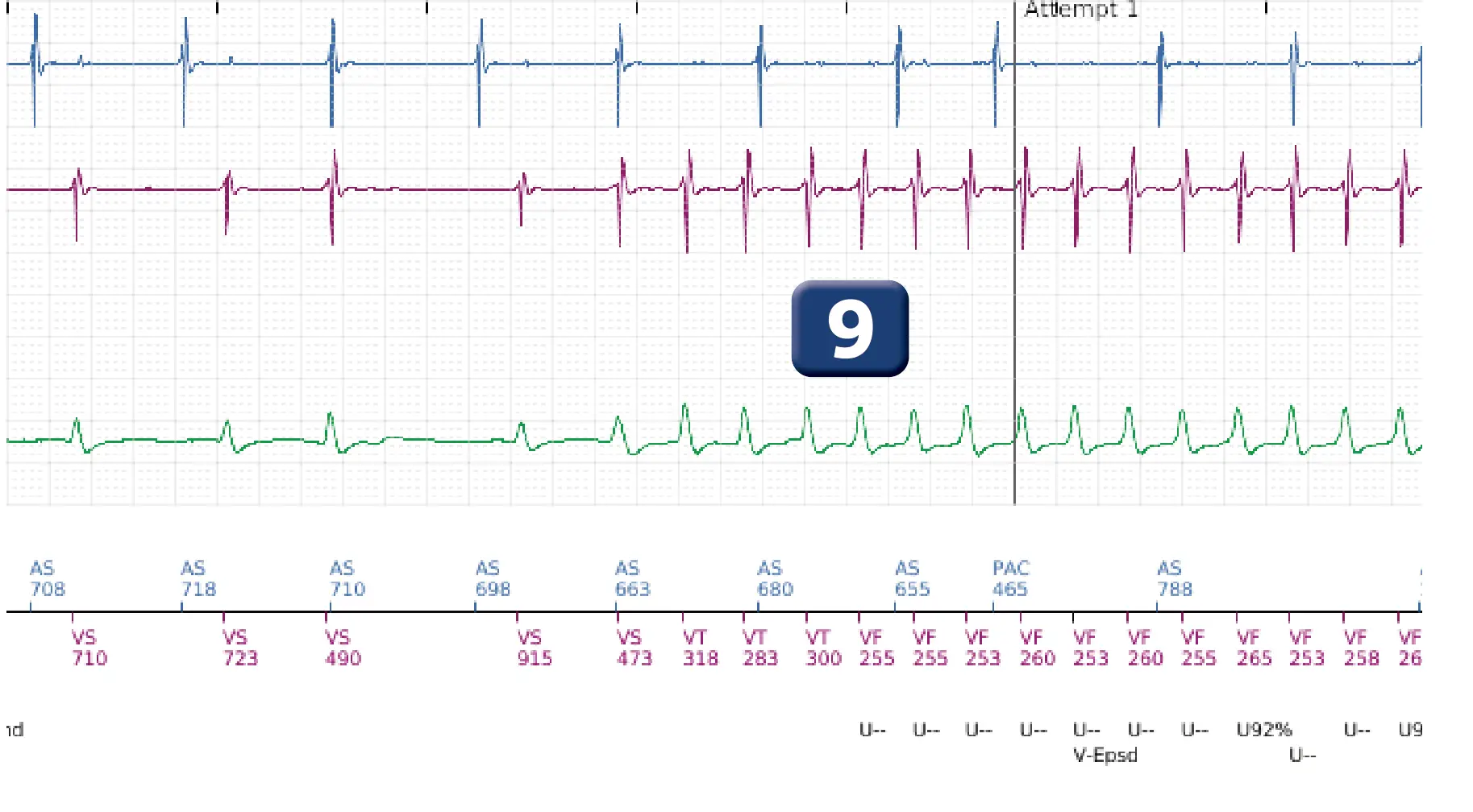 Boston Scientific ICD electrogram, segment 5 of 12 — ATP burst in the VF zone