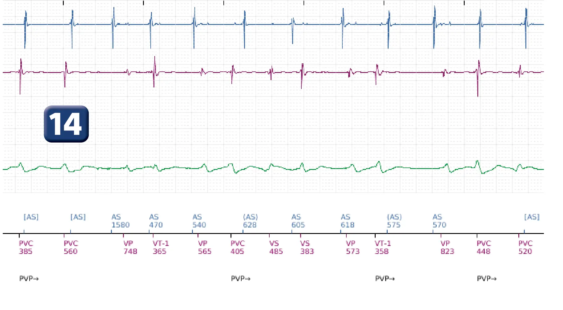 Boston Scientific ICD electrogram, segment 8 of 12 — ATP burst in the VF zone