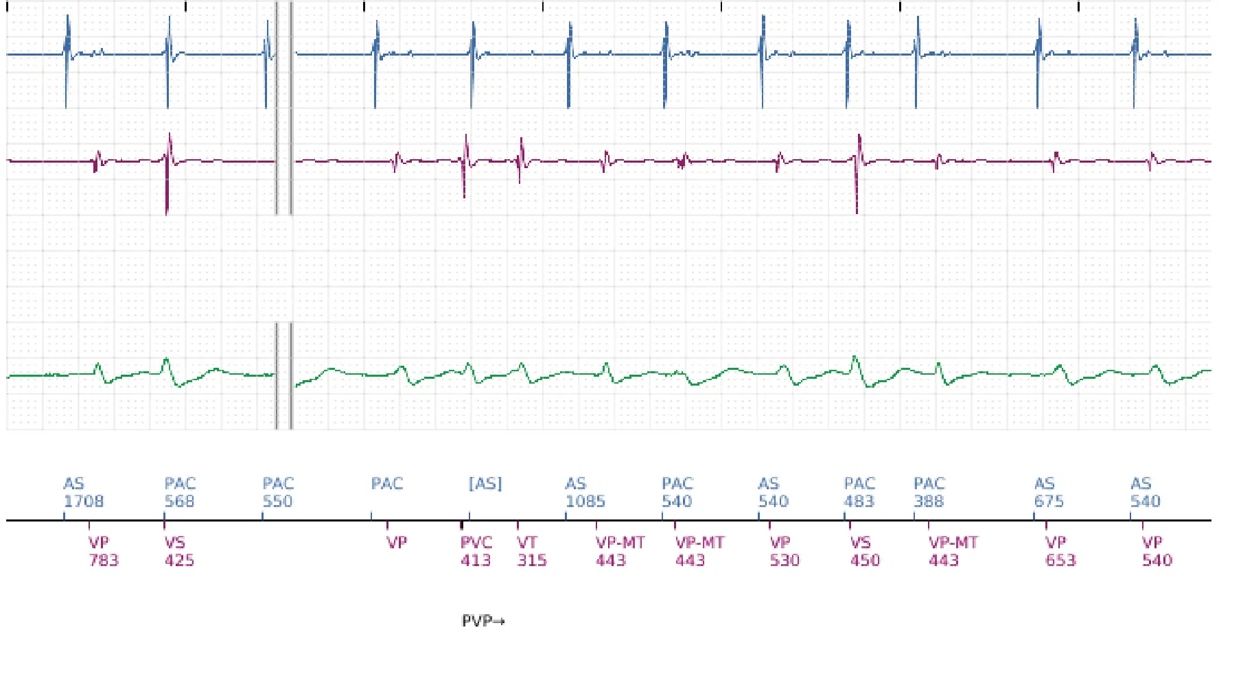 Boston Scientific ICD electrogram, segment 9 of 12 — ATP burst in the VF zone
