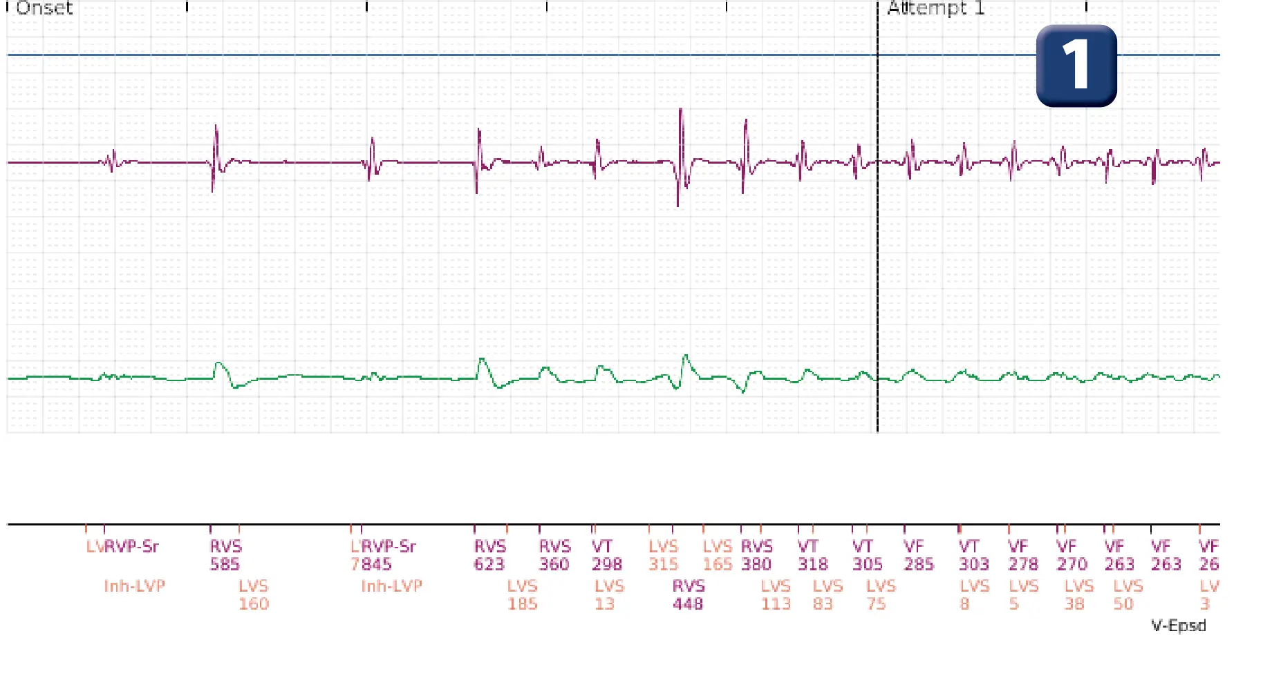 Boston Scientific ICD electrogram, segment 1 of 4 — ATP burst in the VF zone with acceleration