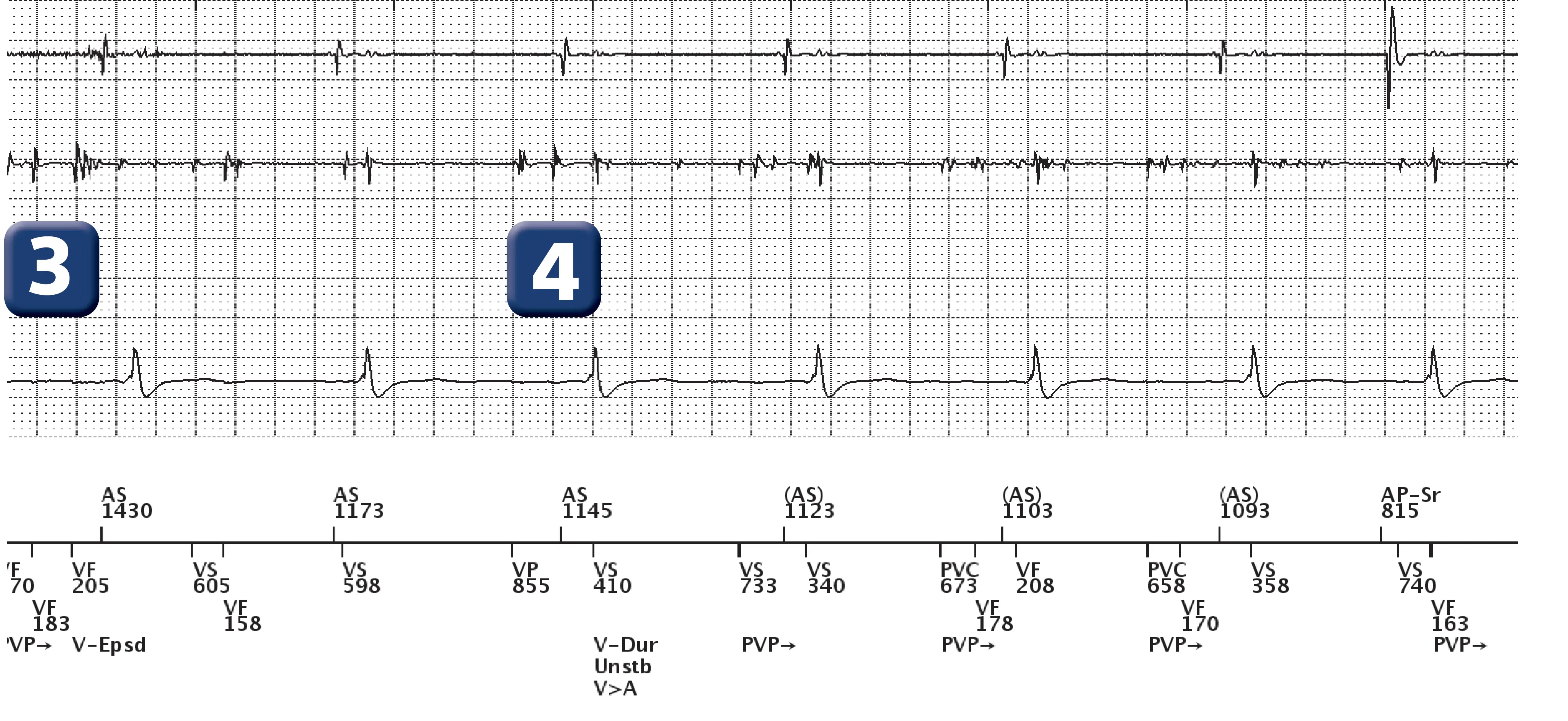 Boston Scientific ICD electrogram, segment 2 of 6 — Oversensing and anti-tachycardia pacing in the VF zone