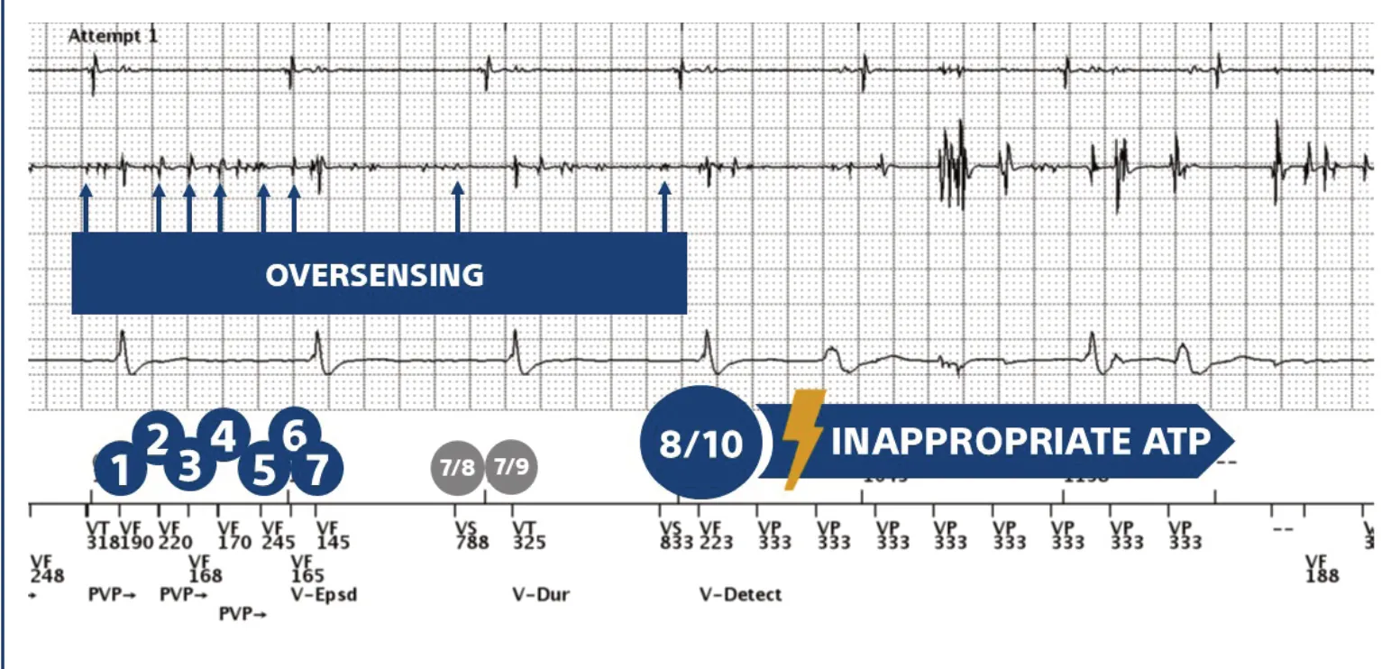 This figure shows oversensing and rapid ventricular pacing in the VF zone with intermittent capture