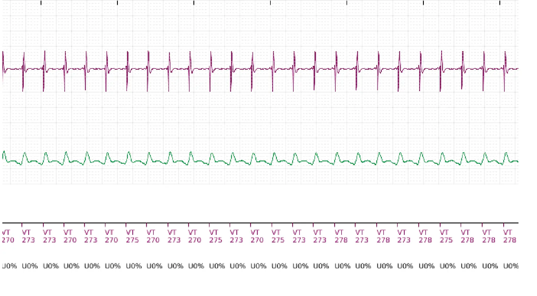 Boston Scientific ICD electrogram, segment 3 of 5 — Single-chamber discrimination, Rhythm ID and a ventricular tachycardia episode