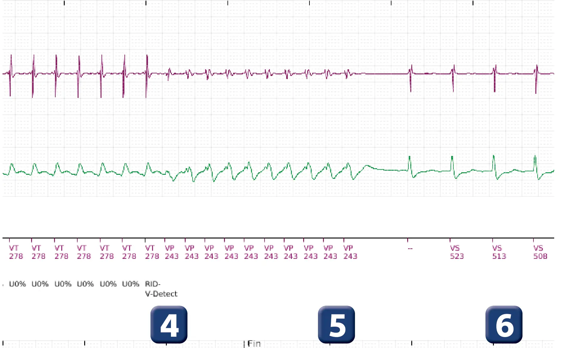 Boston Scientific ICD electrogram, segment 4 of 5 — Single-chamber discrimination, Rhythm ID and a ventricular tachycardia episode