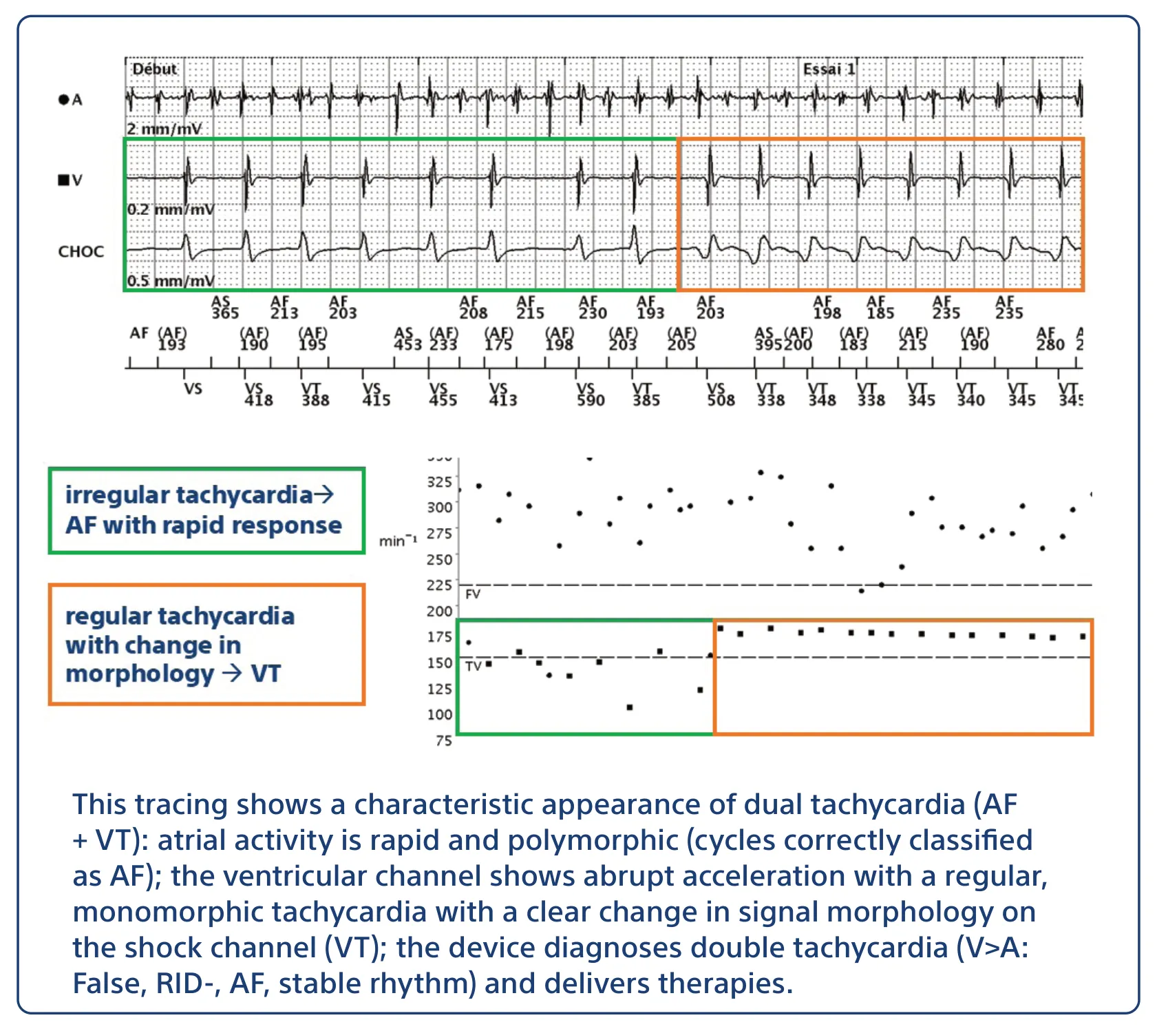 This tracing shows a characteristic appearance of dual tachycardia (AF + VT): atrial activity is rapid and polymorphic (cycles correctly classified as AF); the ventricular channel shows abrupt acceleration with a regular, monomorphic tachycardia with a clear change in signal morphology on the shock channel (VT); the device diagnoses double tachycardia (V>A: False, RID-, AF, stable rhythm) and delivers therapies.