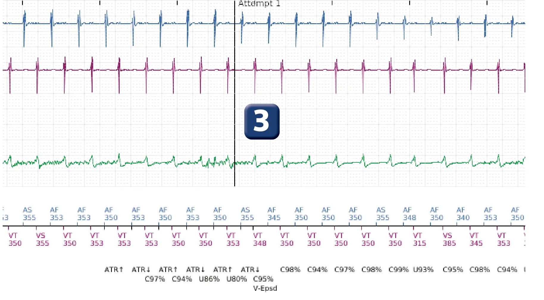 Boston Scientific ICD electrogram, segment 2 of 10 — Dual-chamber discrimination and discrimination error due to signal variability on the shock channel