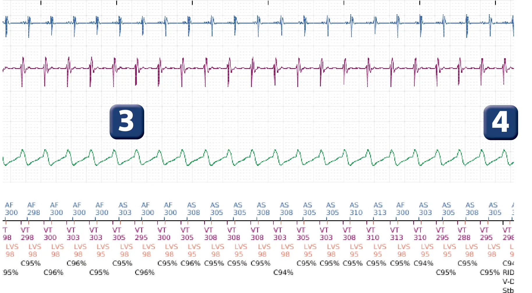 Boston Scientific ICD electrogram, segment 3 of 5 — Dual-chamber discrimination and discrimination error due to inappropriate programming of the correlation percentage