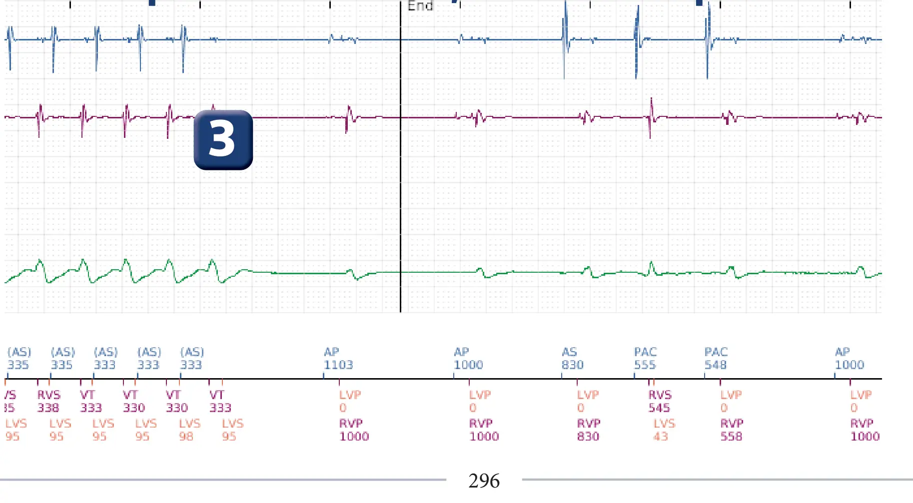 Boston Scientific ICD electrogram, segment 3 of 3 — Dual-chamber discrimination and discrimination error due to inappropriate programming of the correlation percentage