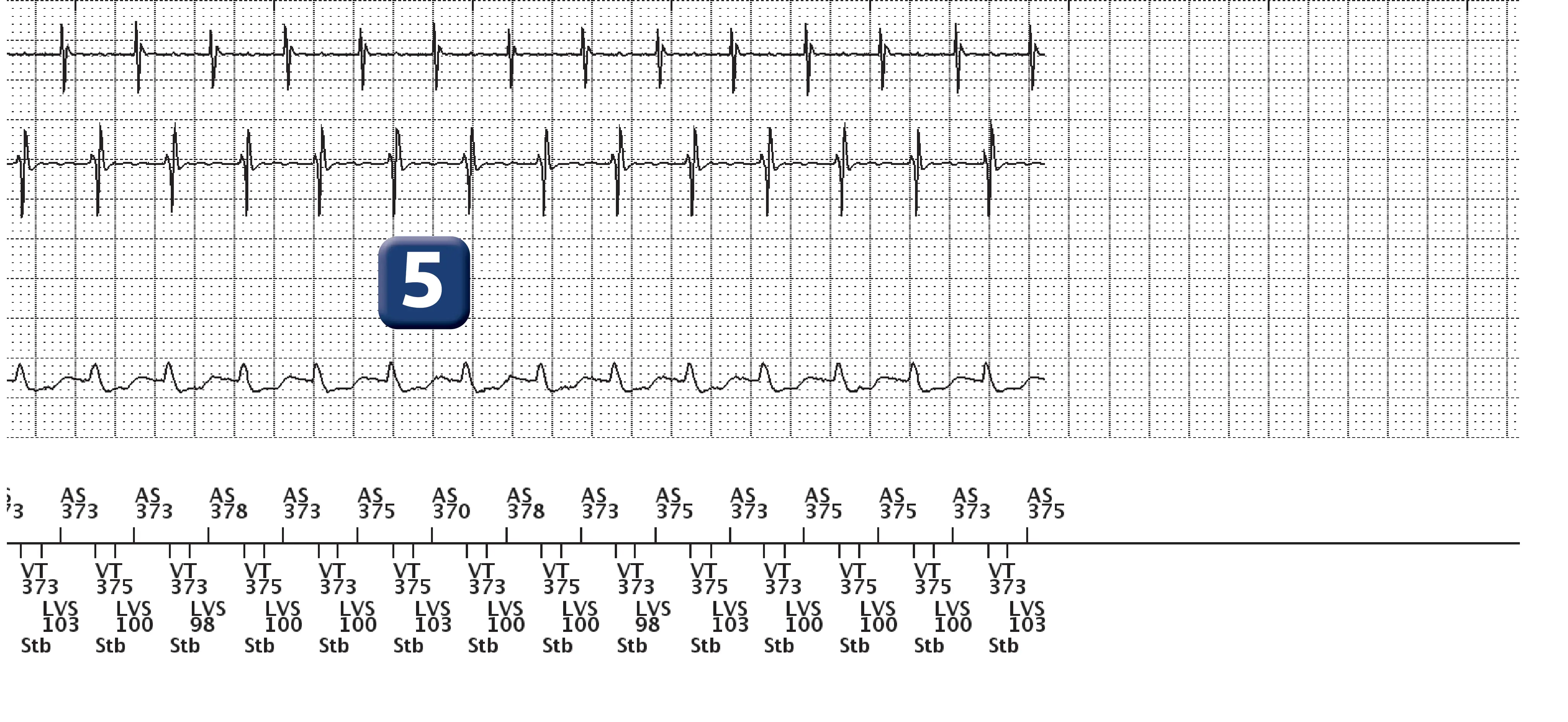 Boston Scientific ICD electrogram, segment 3 of 3 — Dual-chamber discrimination, atrial tachycardia