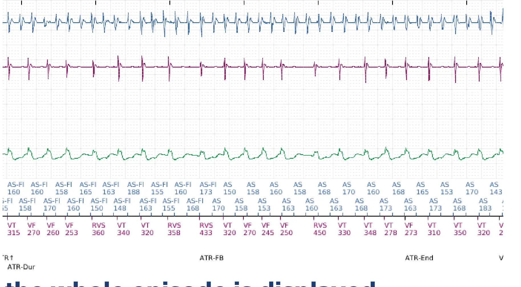 Boston Scientific ICD electrogram, segment 10 of 12 — Dual-chamber discrimination and atrial fibrillation
