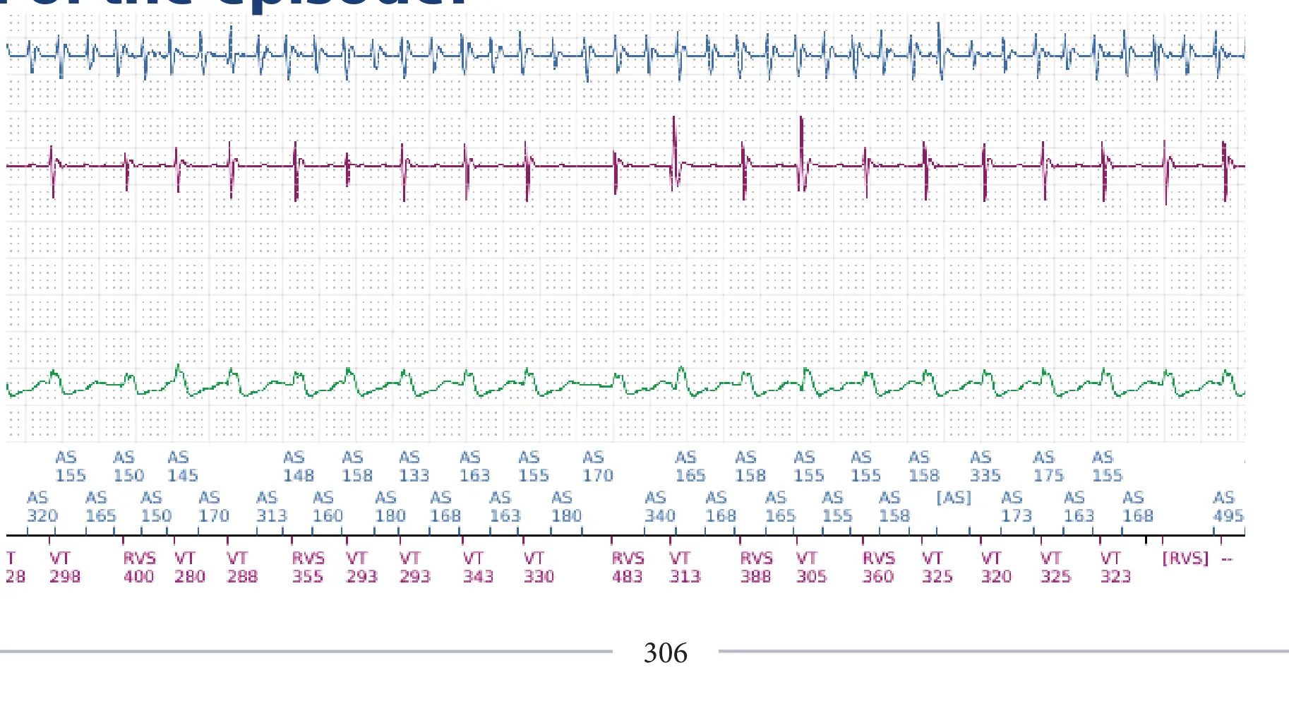 Boston Scientific ICD electrogram, segment 11 of 12 — Dual-chamber discrimination and atrial fibrillation