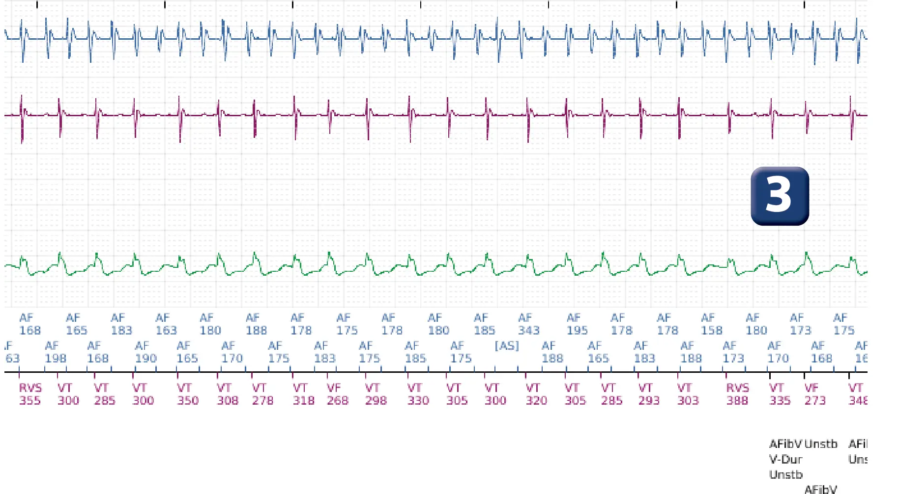 Boston Scientific ICD electrogram, segment 6 of 12 — Dual-chamber discrimination and atrial fibrillation