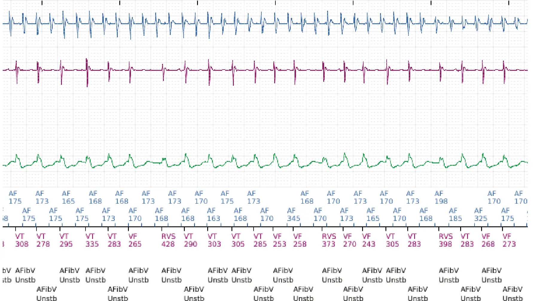 Boston Scientific ICD electrogram, segment 7 of 12 — Dual-chamber discrimination and atrial fibrillation