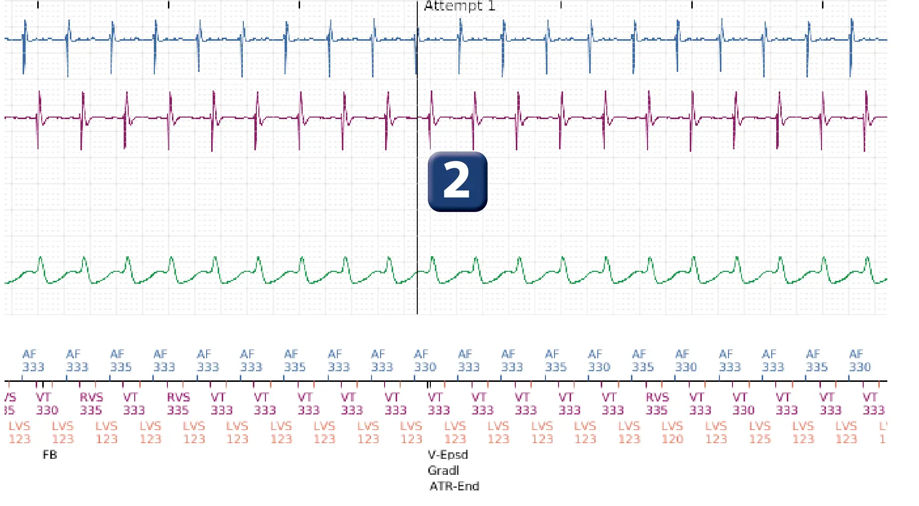 Boston Scientific ICD electrogram, segment 2 of 3 — Dual chamber discrimination, atrial tachycardia