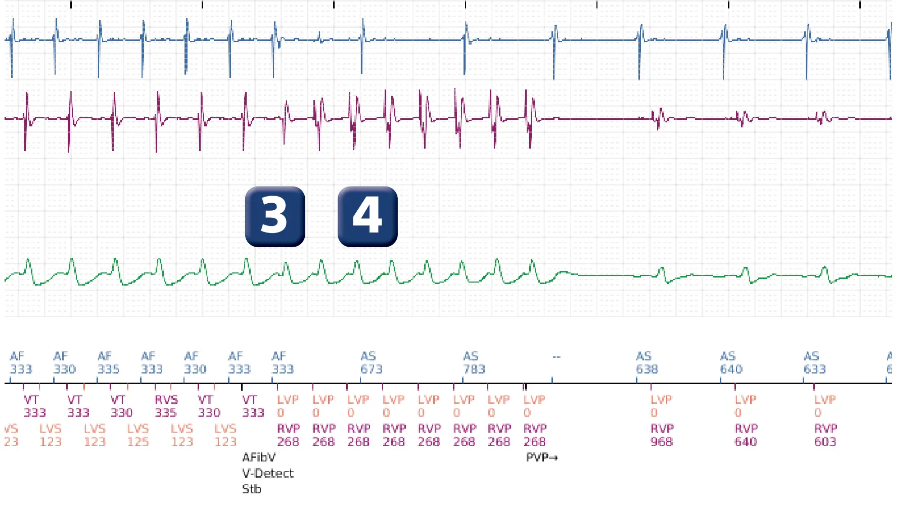 Boston Scientific ICD electrogram, segment 3 of 3 — Dual chamber discrimination, atrial tachycardia