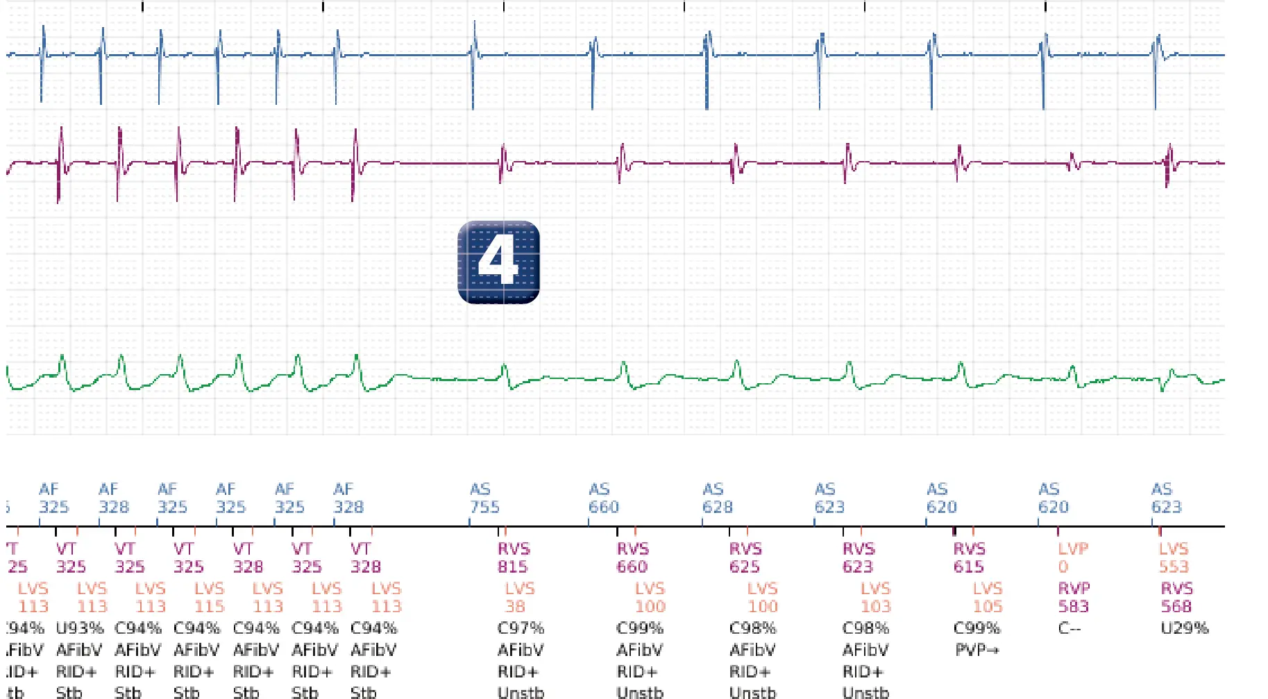 Boston Scientific ICD electrogram, segment 4 of 4 — Dual chamber discrimination, atrial tachycardia