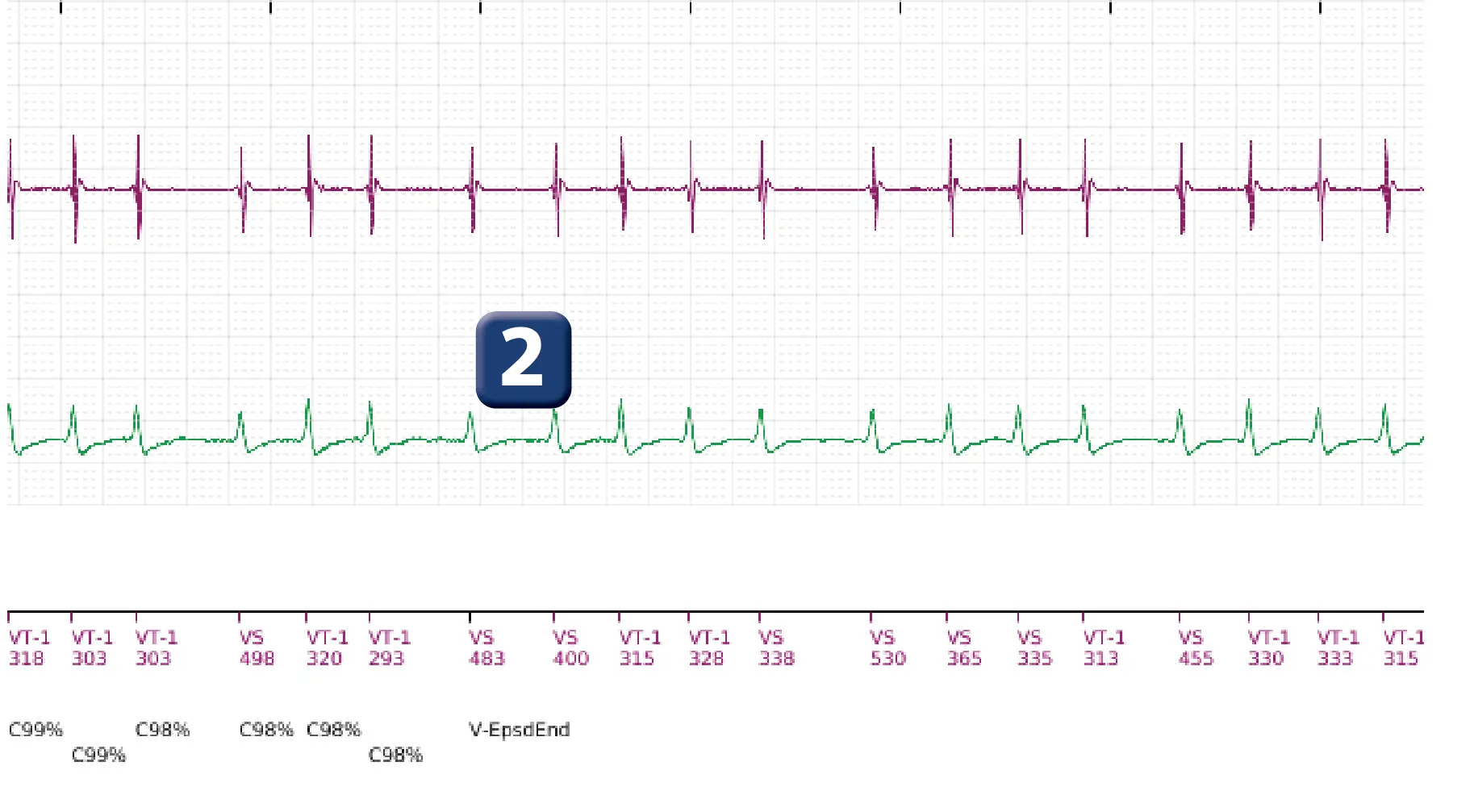 Boston Scientific ICD electrogram, segment 2 of 5 — Single-chamber discrimination, Rhythm ID and an atrial fibrillation episode