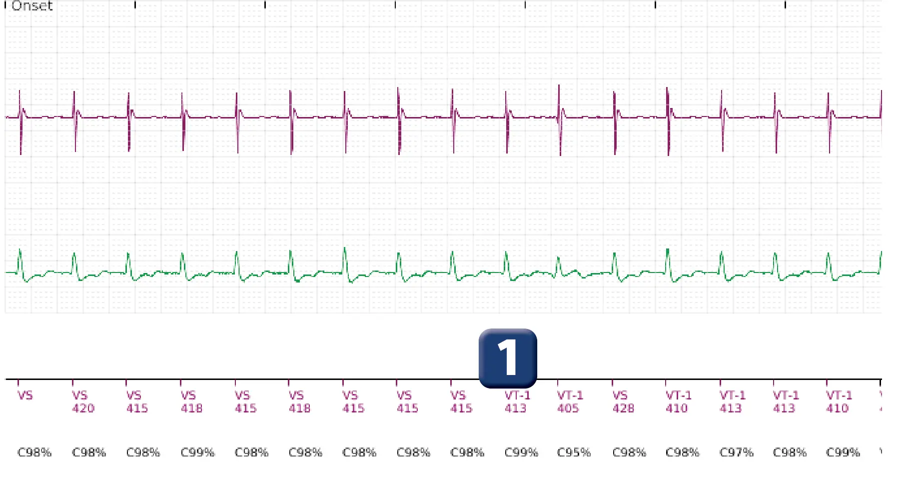 Boston Scientific ICD electrogram, segment 1 of 6 — Single-chamber discrimination, Rhythm ID and sinus tachycardia