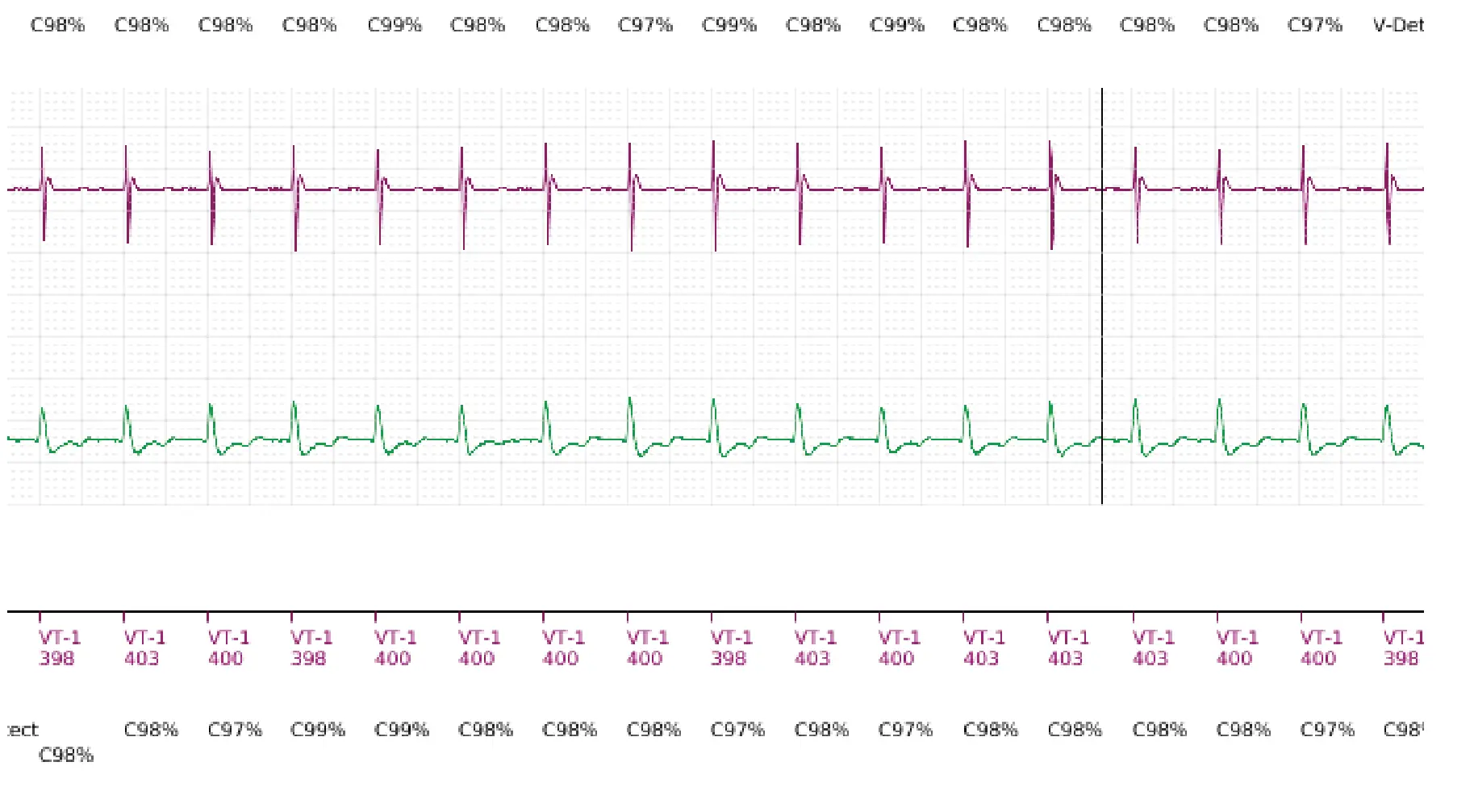 Boston Scientific ICD electrogram, segment 4 of 6 — Single-chamber discrimination, Rhythm ID and sinus tachycardia