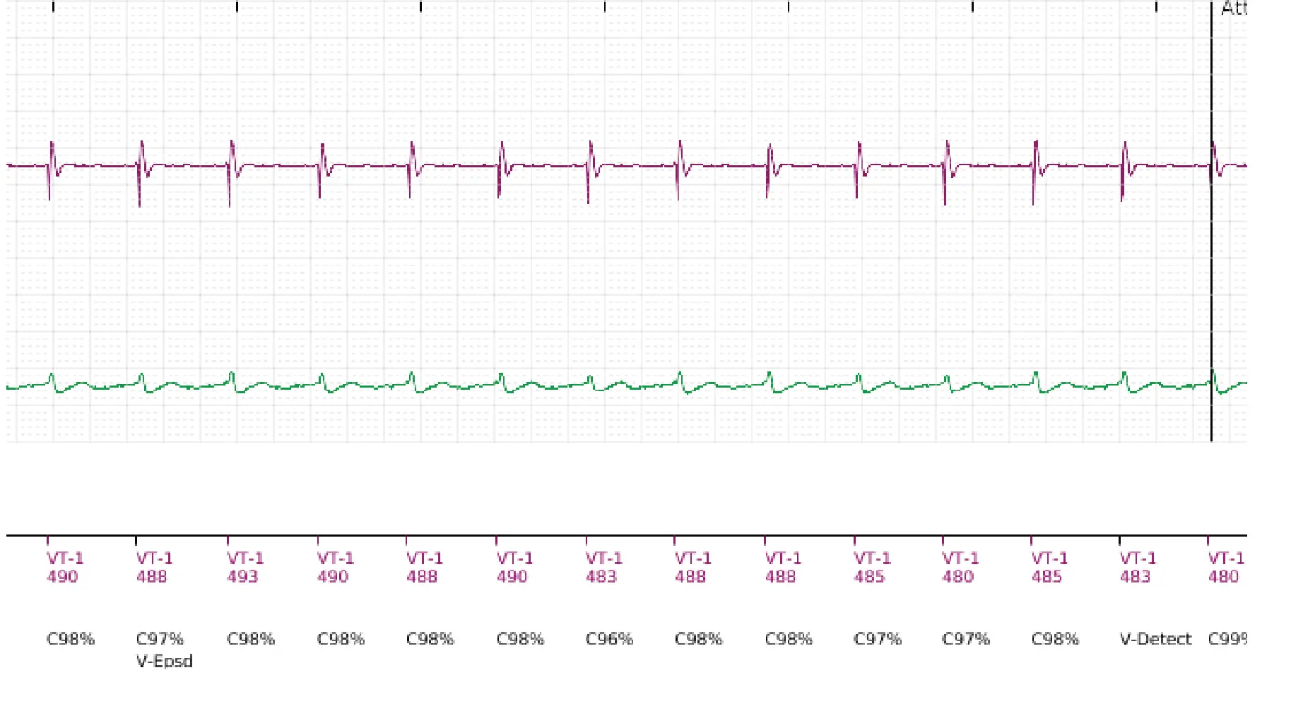 Boston Scientific ICD electrogram, segment 2 of 11 — Single-chamber discrimination, Rhythm ID and correlation percentage