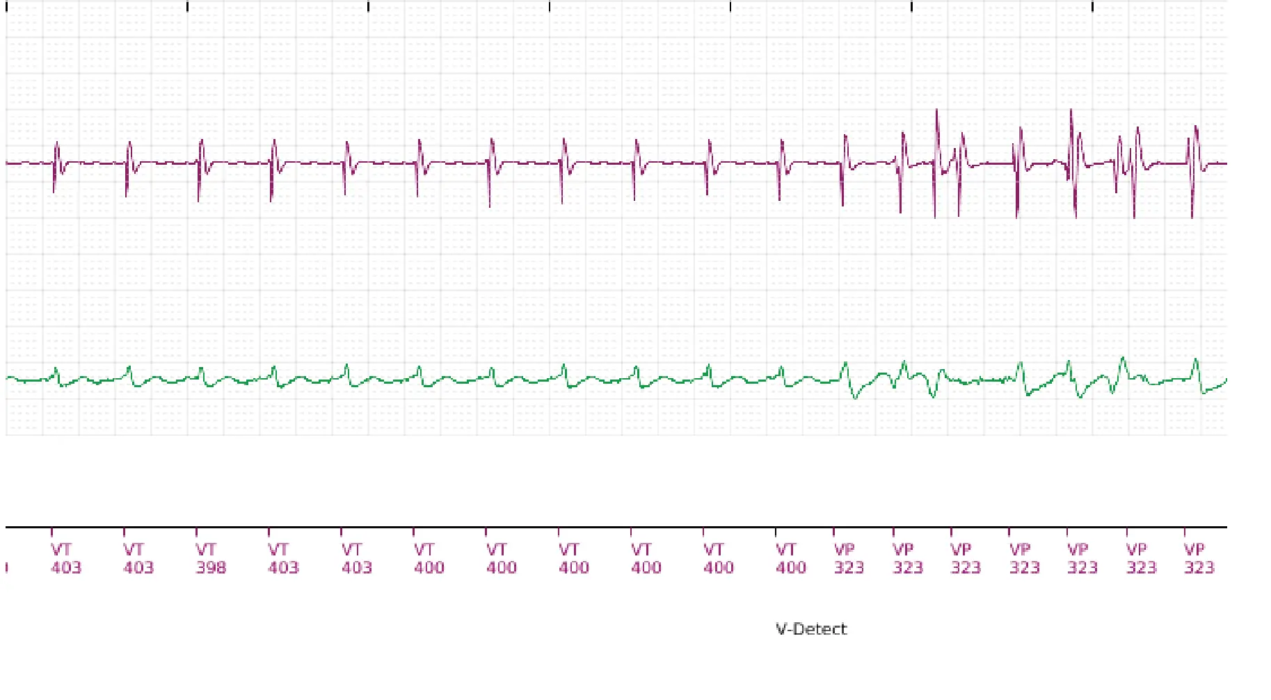 Boston Scientific ICD electrogram, segment 9 of 11 — Single-chamber discrimination, Rhythm ID and correlation percentage
