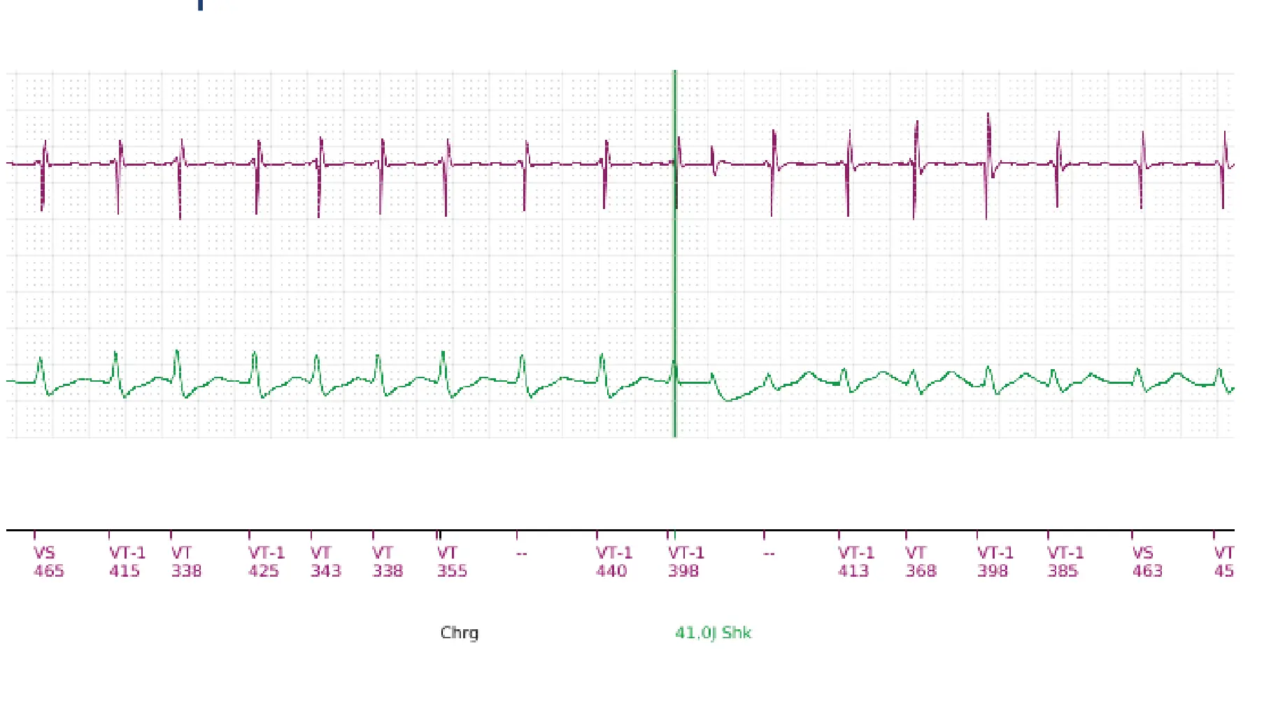 Boston Scientific ICD electrogram, segment 16 of 18 — Single-chamber discrimination, Rhythm ID and SRD