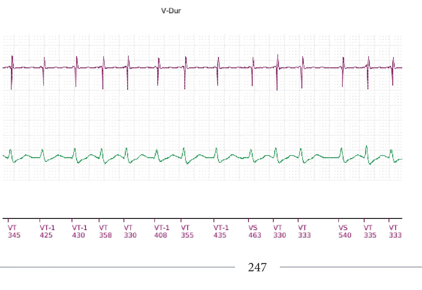 Boston Scientific ICD electrogram, segment 18 of 18 — Single-chamber discrimination, Rhythm ID and SRD