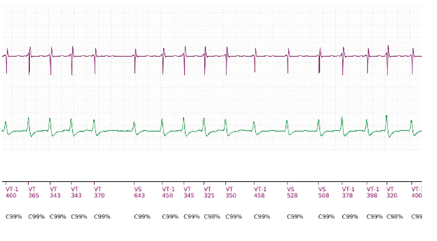 Boston Scientific ICD electrogram, segment 4 of 18 — Single-chamber discrimination, Rhythm ID and SRD