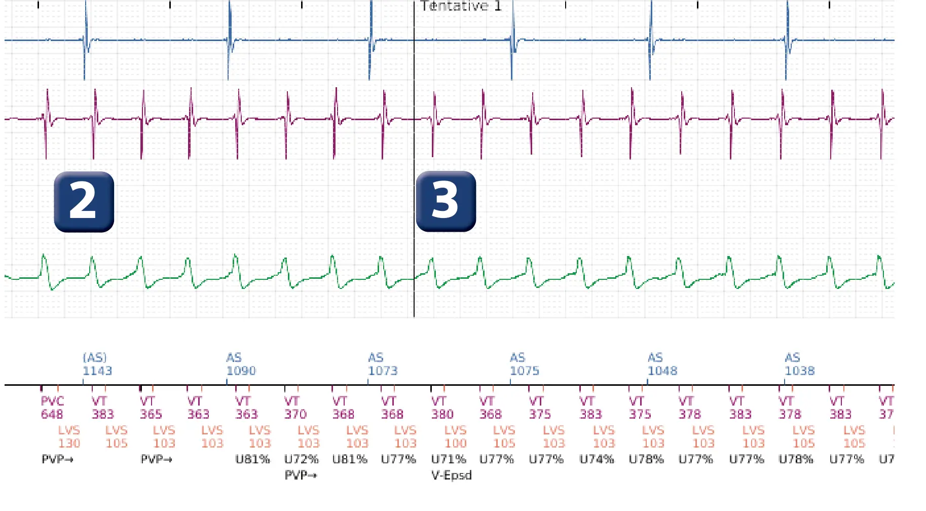 Boston Scientific ICD electrogram, segment 2 of 5 — Dual chamber discrimination and V>A