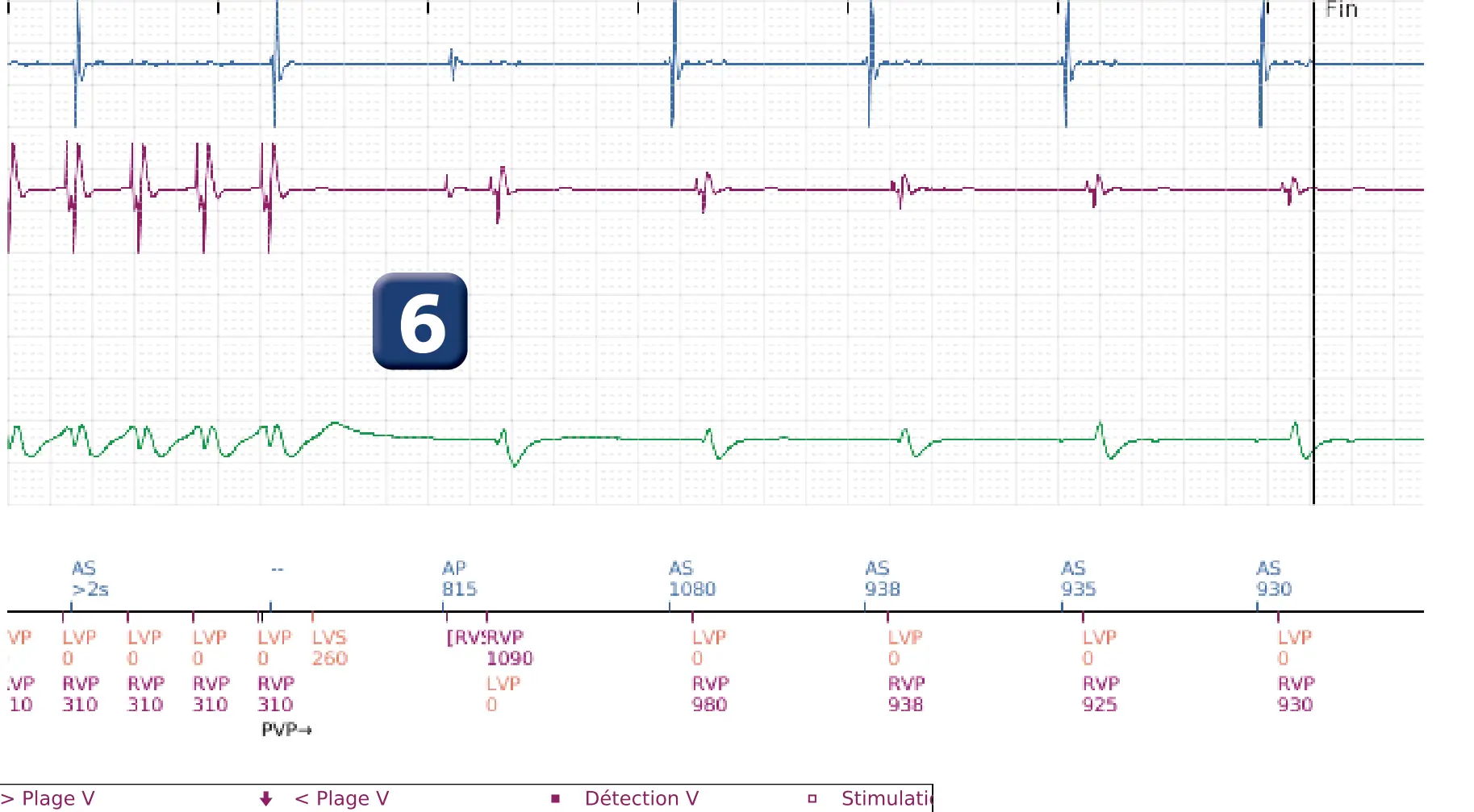 Boston Scientific ICD electrogram, segment 5 of 5 — Dual chamber discrimination and V>A