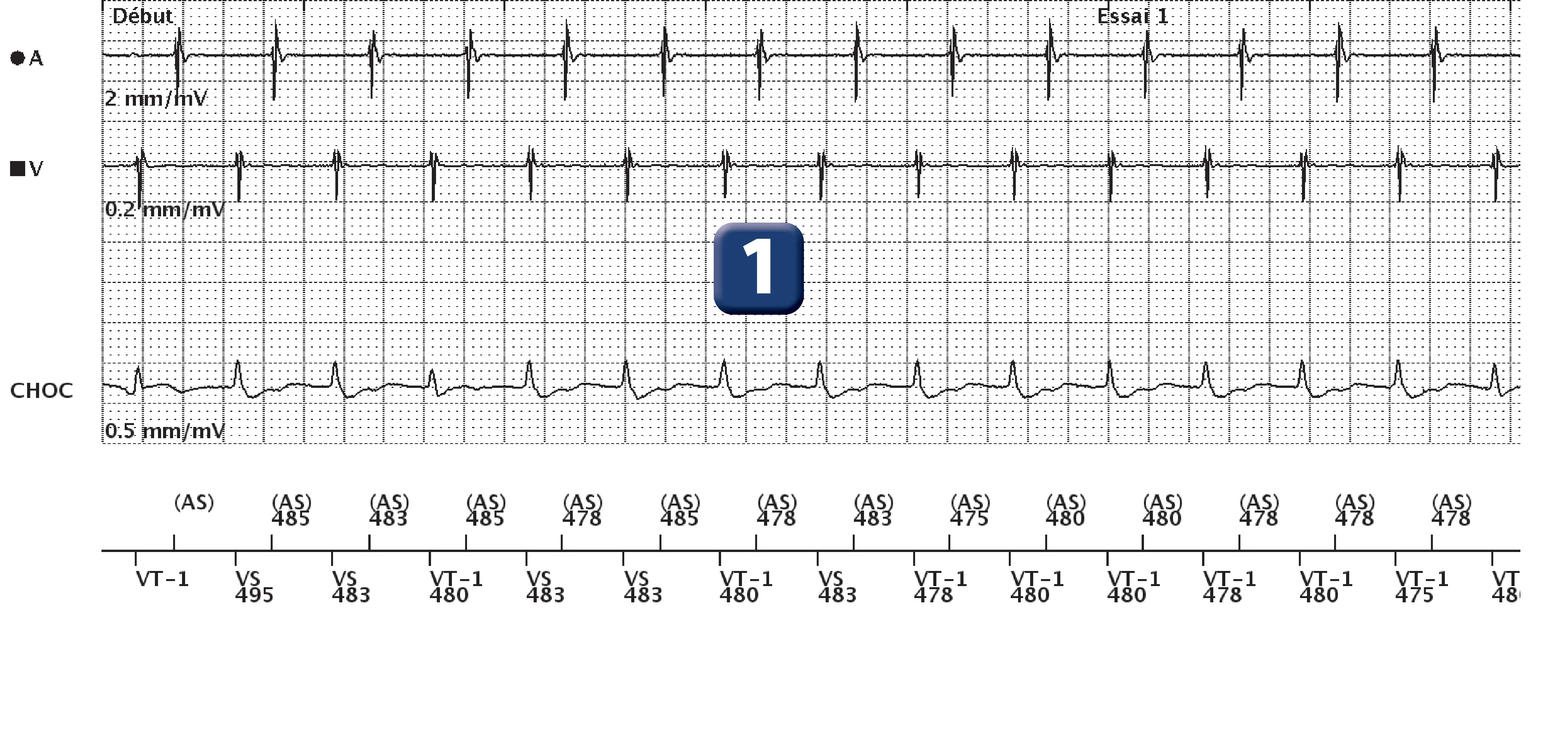 Boston Scientific ICD electrogram, segment 1 of 13 — Dual-chamber discrimination, atrial refractory periods and V>A criterion