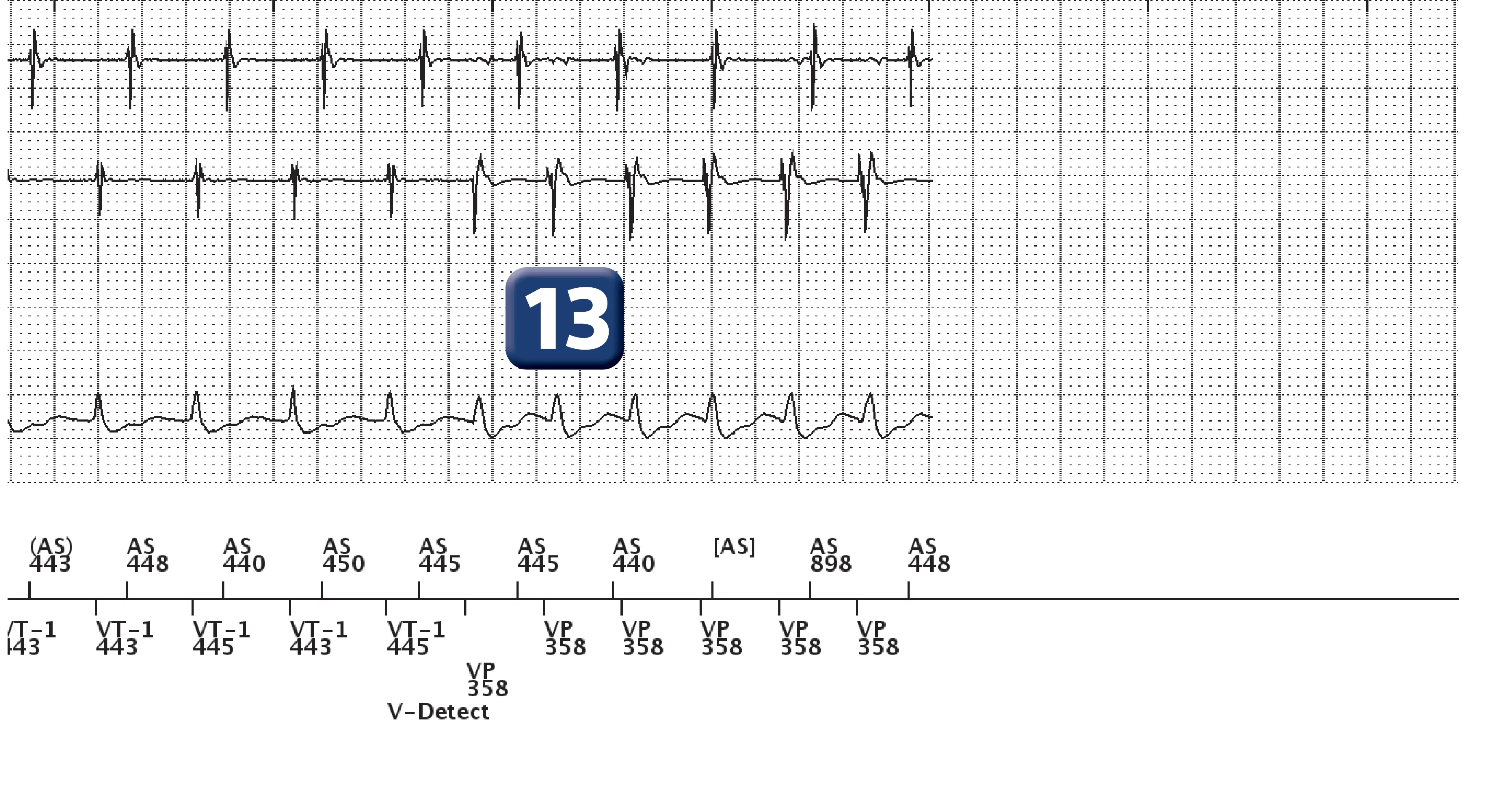 Boston Scientific ICD electrogram, segment 8 of 13 — Dual-chamber discrimination, atrial refractory periods and V>A criterion