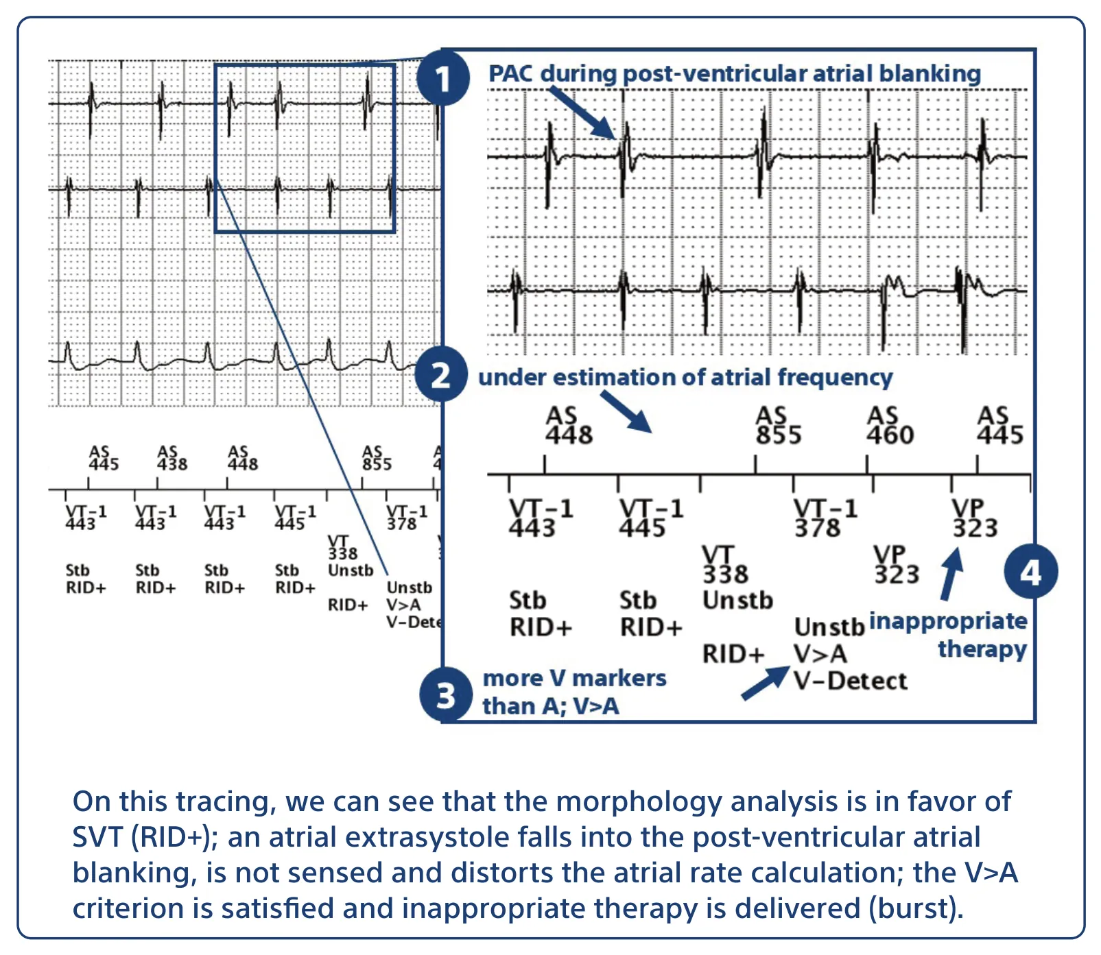 On this tracing, we can see that the morphology analysis is in favor of SVT (RID+); an atrial extrasystole falls into the post-ventricular atrial blanking, is not sensed and distorts the atrial rate calculation; the V>A criterion is satisfied and inappropriate therapy is delivered (burst).
