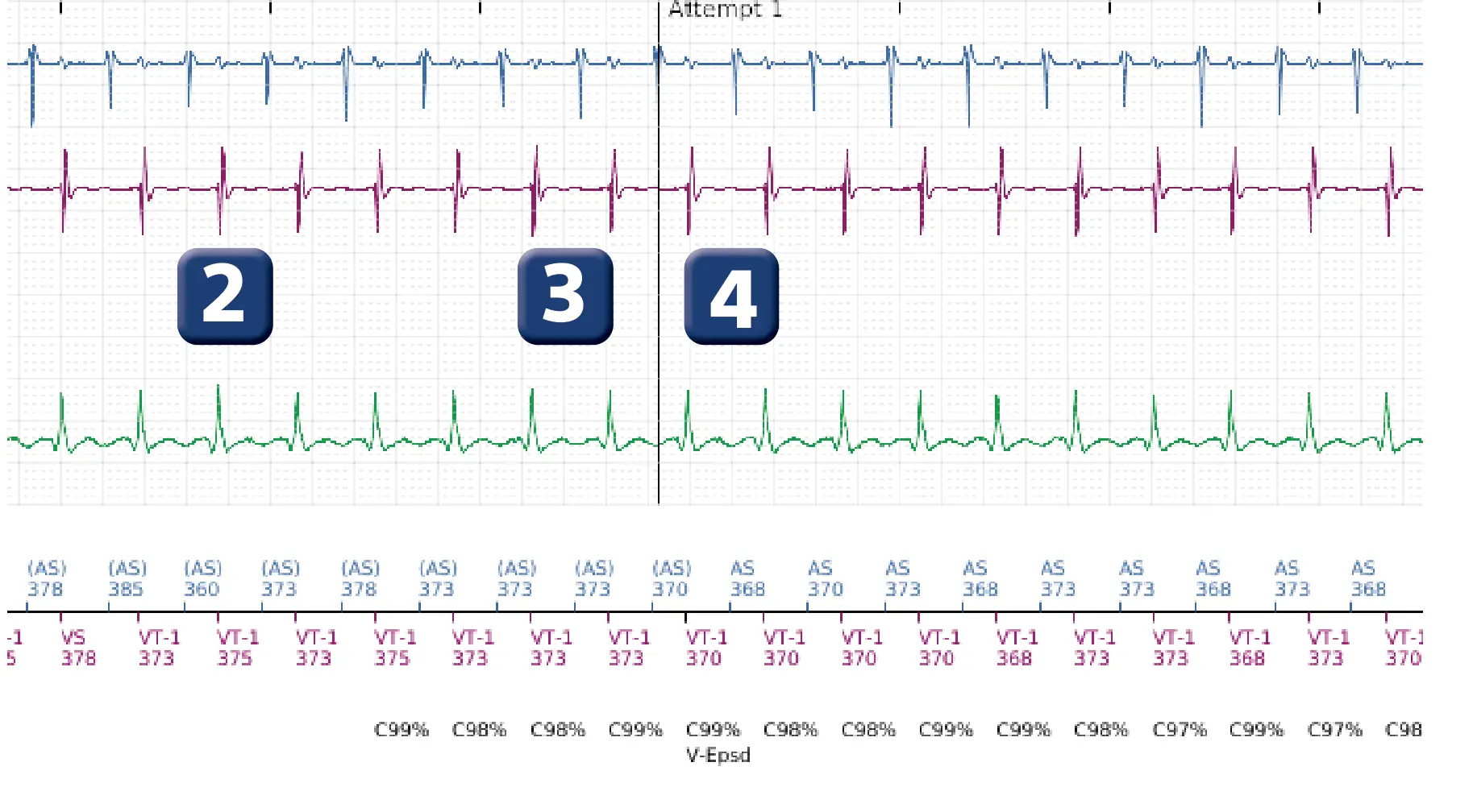 Boston Scientific ICD electrogram, segment 2 of 5 — Dual-chamber discrimination and tachycardia