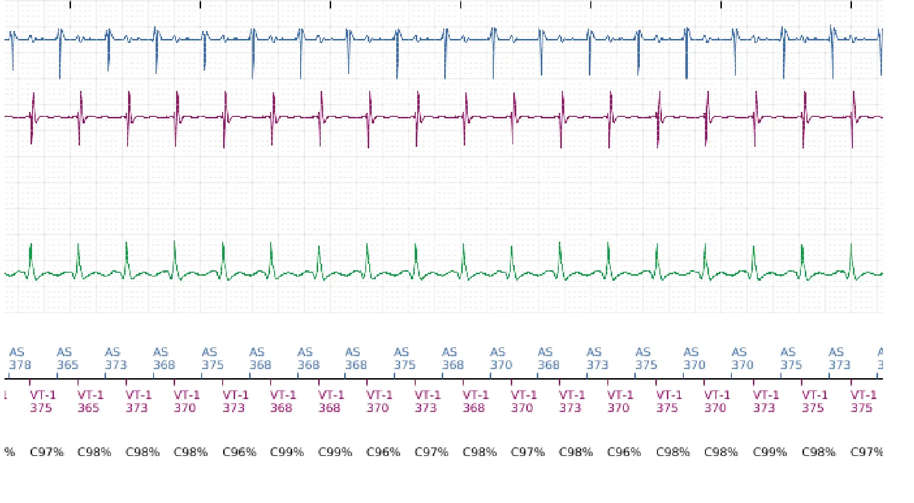 Boston Scientific ICD electrogram, segment 3 of 5 — Dual-chamber discrimination and tachycardia