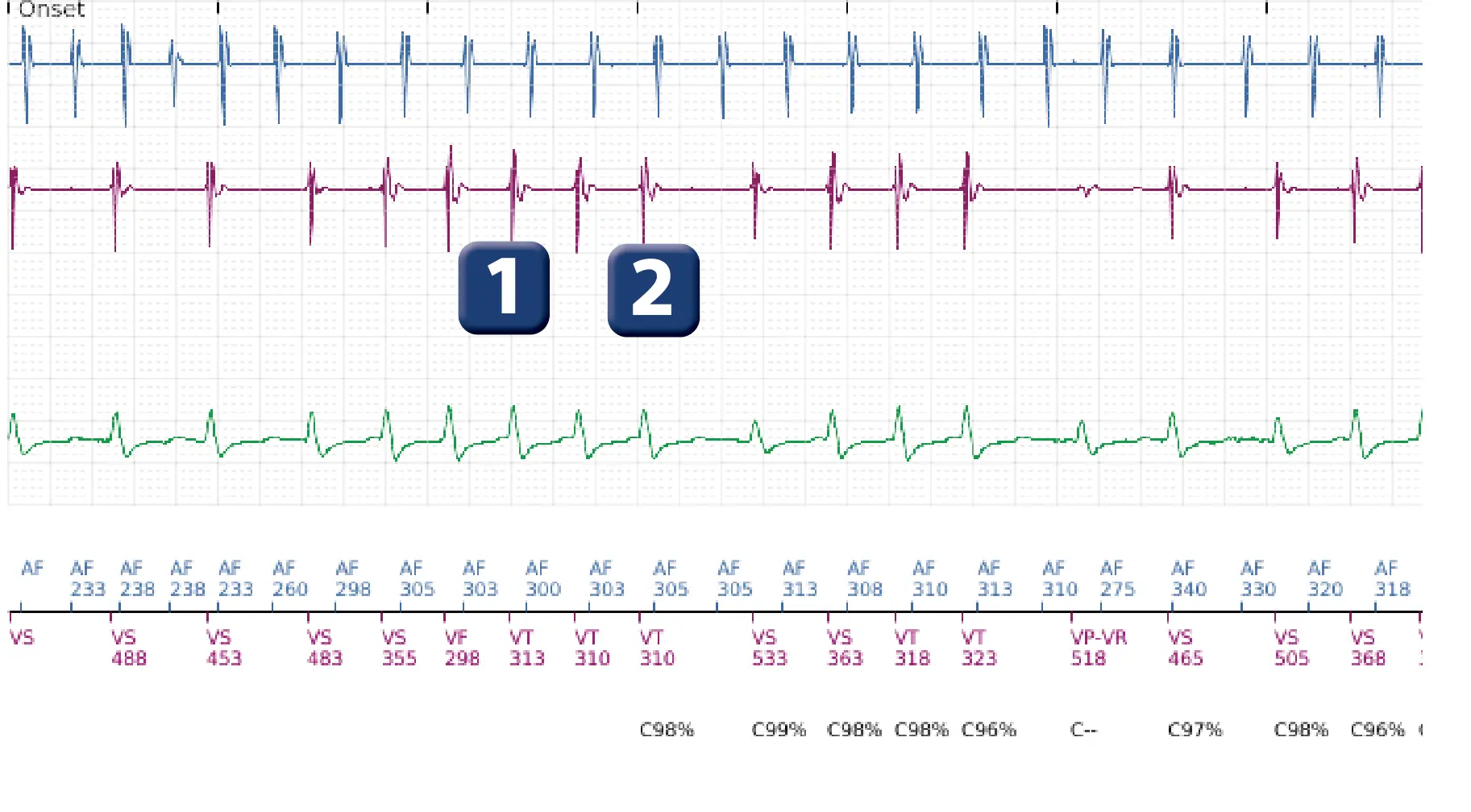 Boston Scientific ICD electrogram, segment 1 of 5 — Dual-chamber discrimination and atrial tachycardia