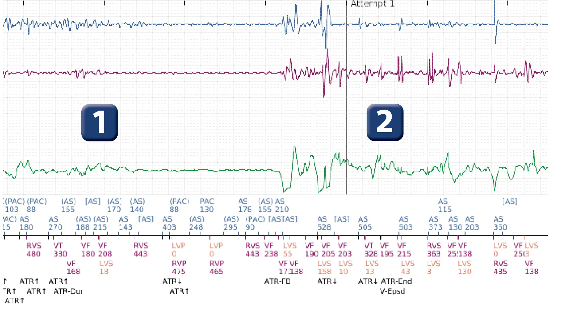 Boston Scientific ICD electrogram, segment 1 of 2 — Surgical intervention and VF at the time of reperfusion