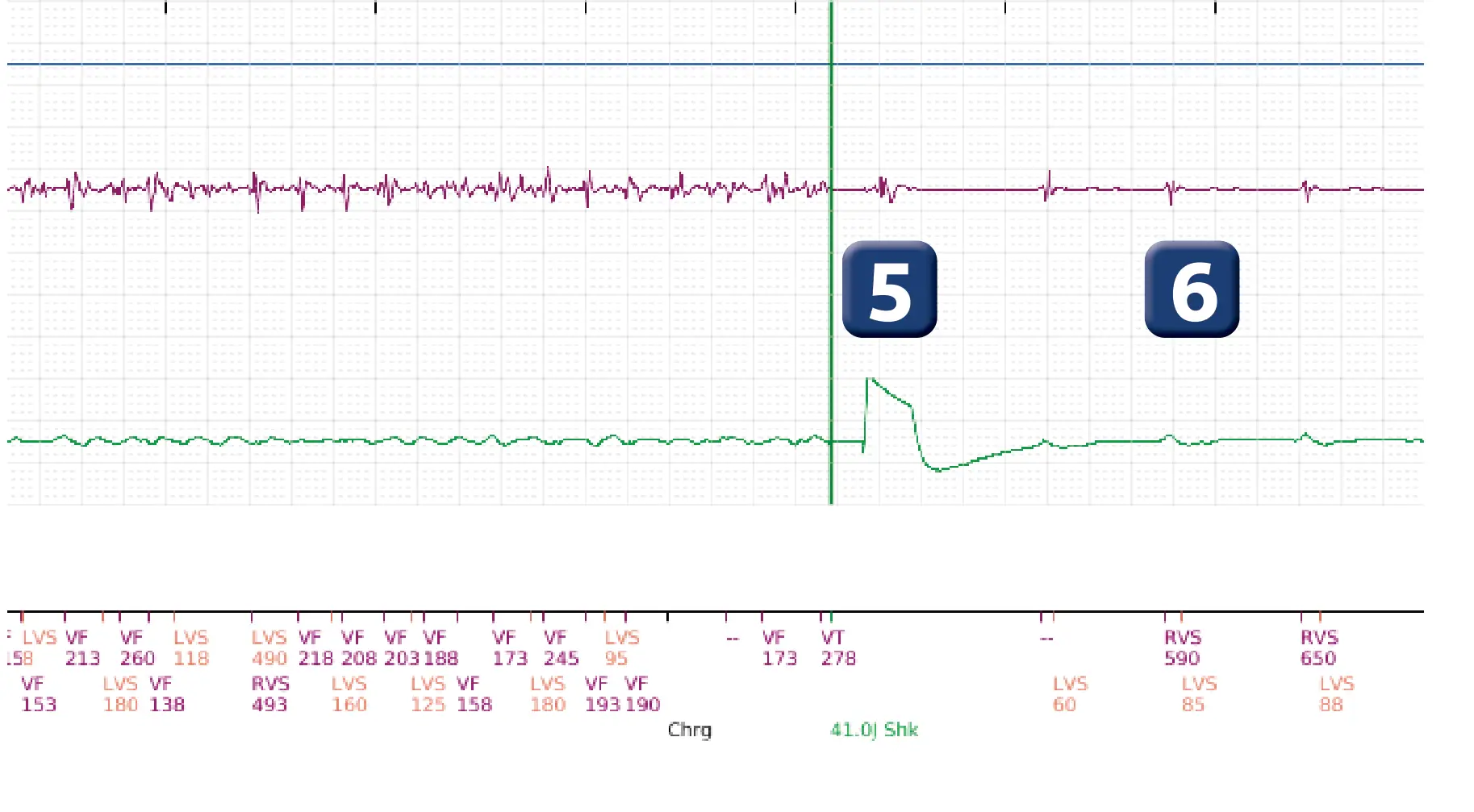 Boston Scientific ICD electrogram, segment 4 of 5 — Surgical intervention and VF at the time of reperfusion