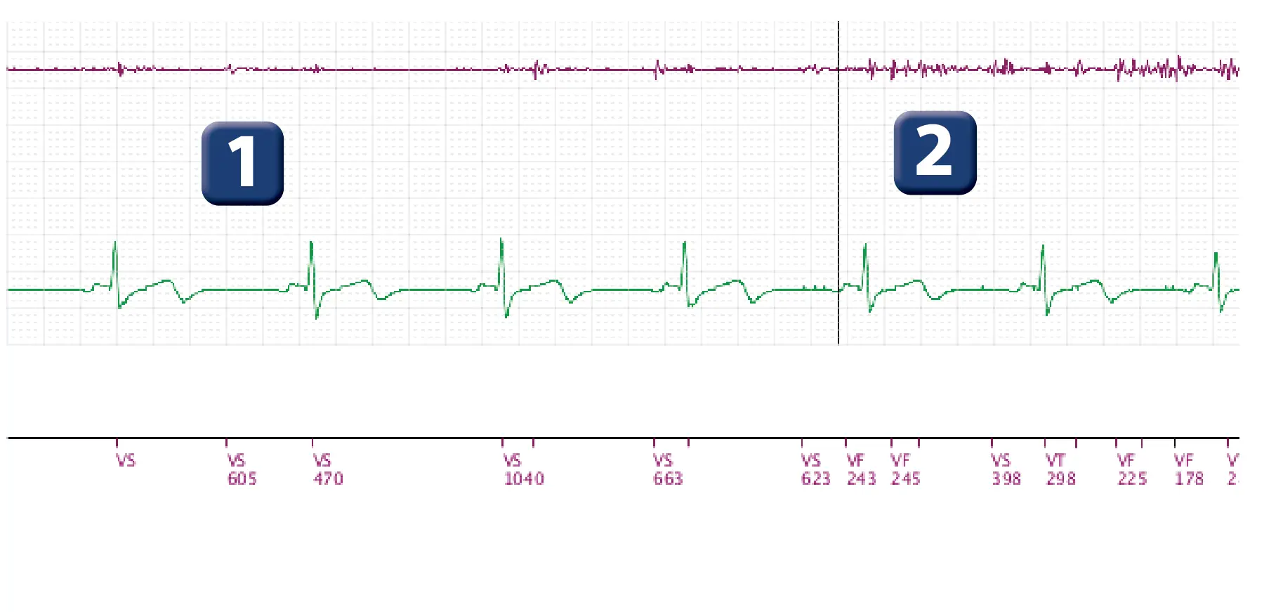 Boston Scientific ICD electrogram, segment 1 of 3 — Lead fracture and multiple capacitor charges