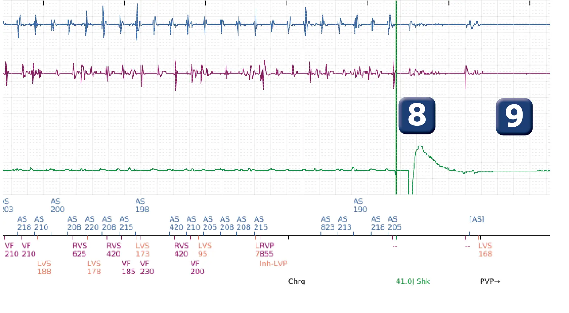 Boston Scientific ICD electrogram, segment 7 of 8 — Early displacement of a right ventricular lead into the atrium