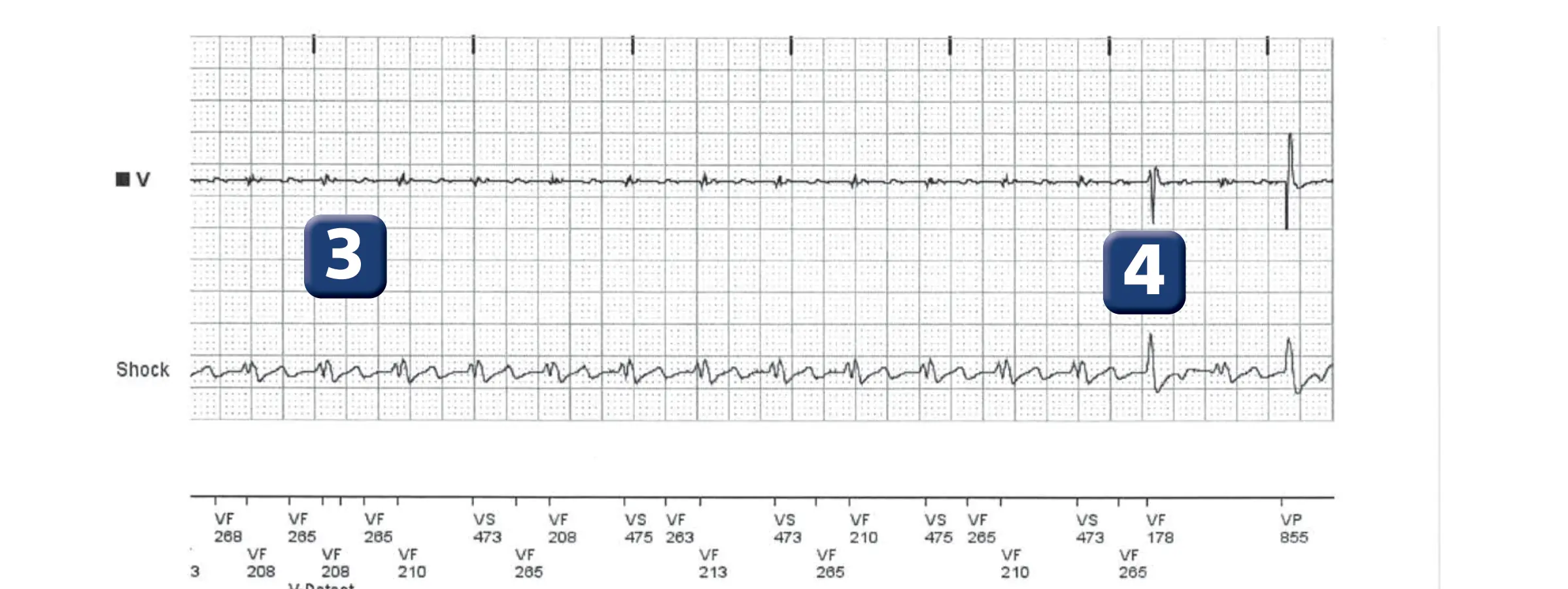 Boston Scientific ICD electrogram, segment 2 of 6 — T wave oversensing