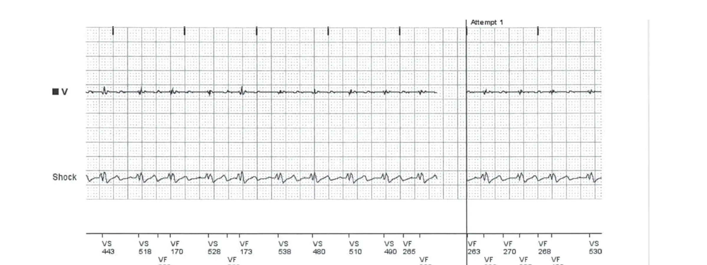 Boston Scientific ICD electrogram, segment 4 of 6 — T wave oversensing