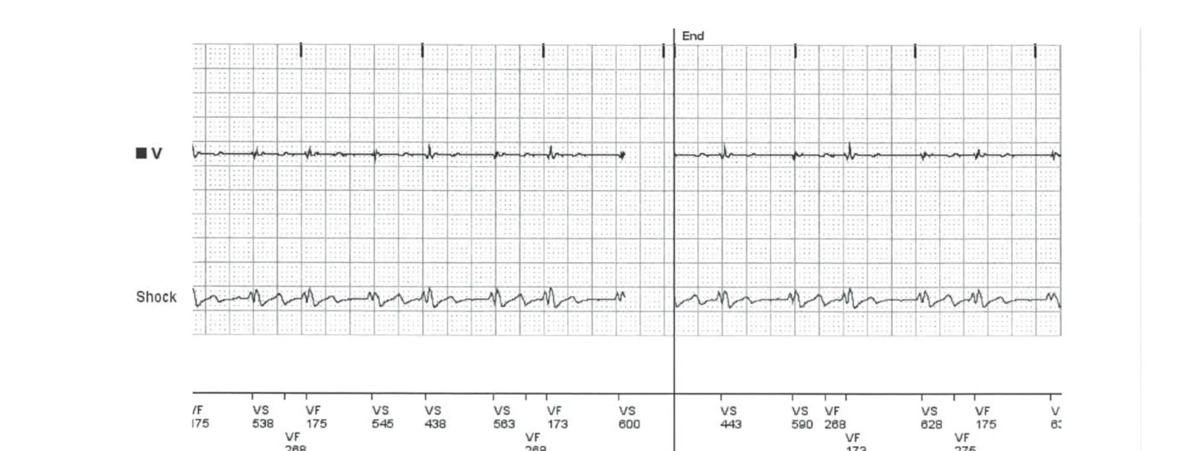 Boston Scientific ICD electrogram, segment 6 of 6 — T wave oversensing