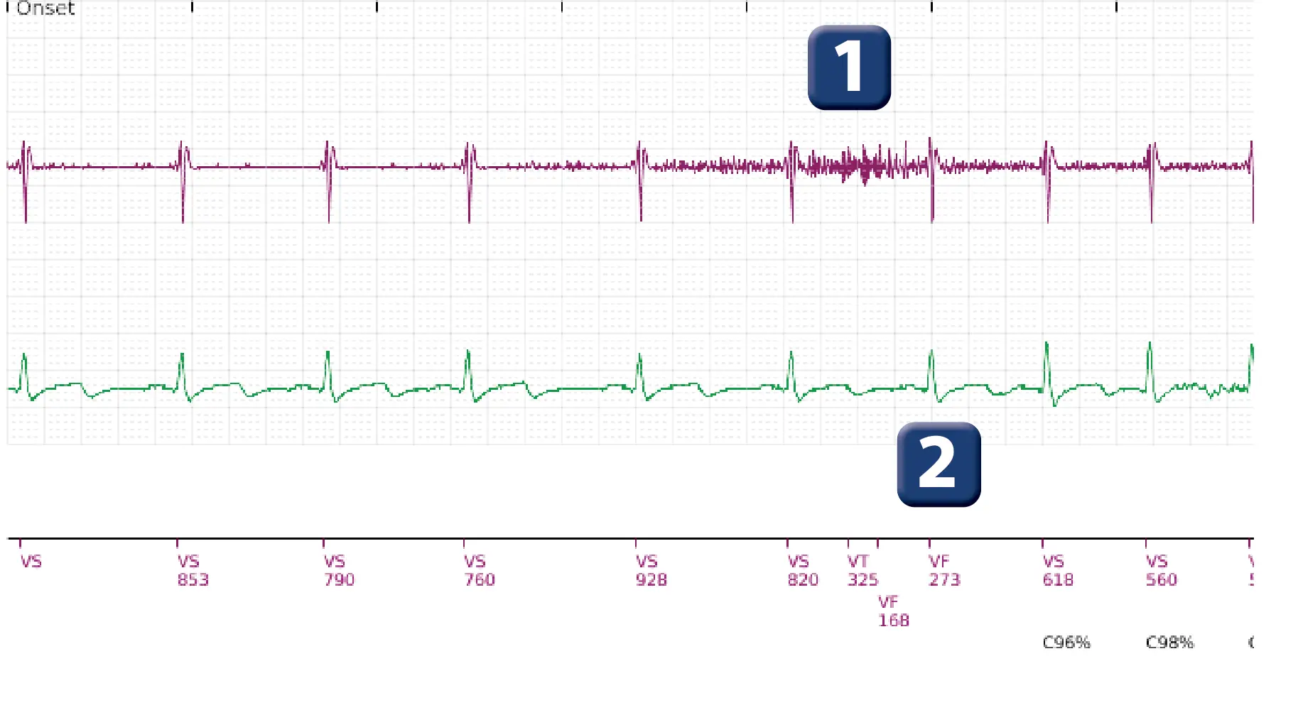 Boston Scientific ICD electrogram, segment 1 of 2 — Oversensing of diaphragmatic myopotentials