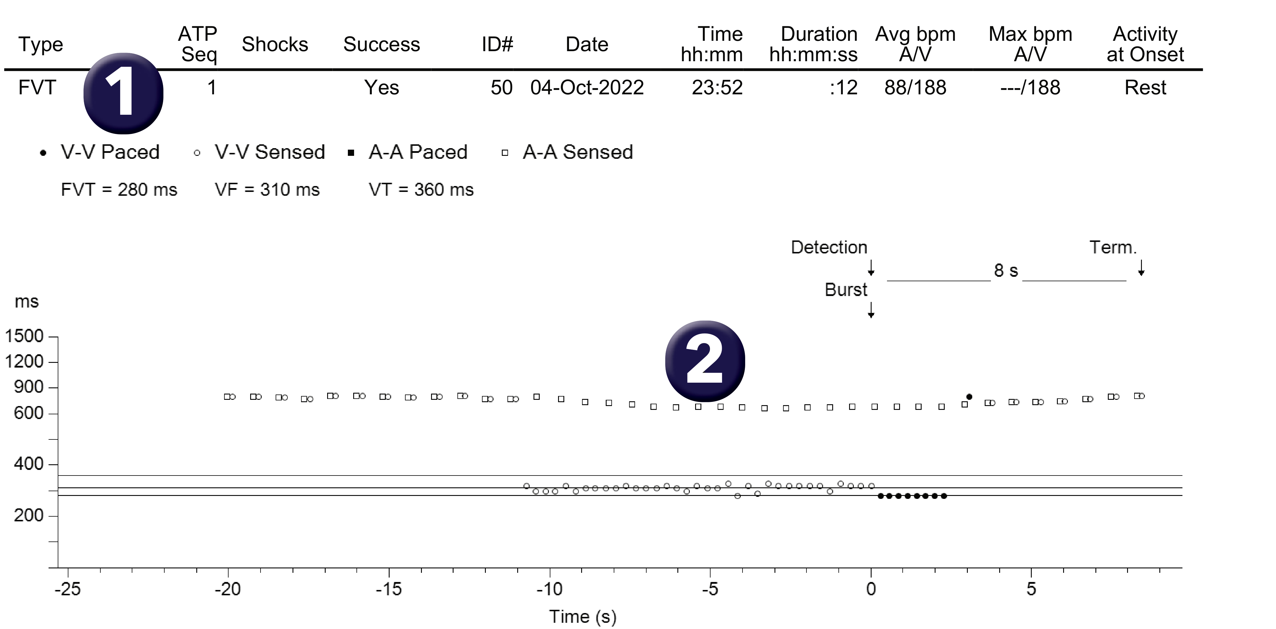 Medtronic ICD electrogram, segment 1 of 1 — Fast VT and the combined counter