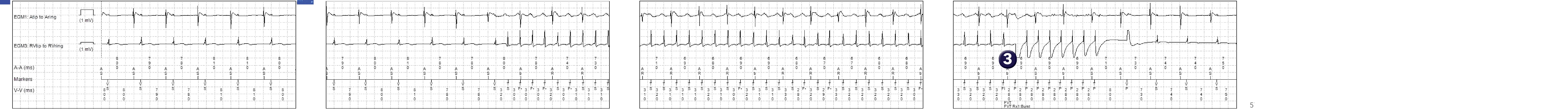 Medtronic ICD electrogram, segment 1 of 1 — Fast VT and the combined counter