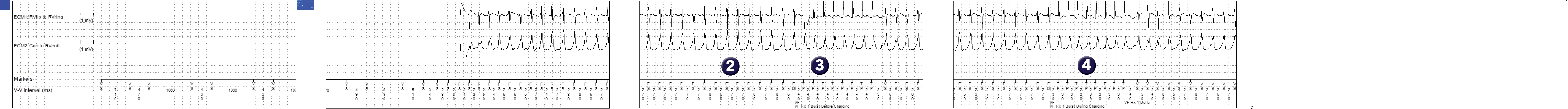 Medtronic ICD electrogram, segment 1 of 2 — No confirmation for a second shock