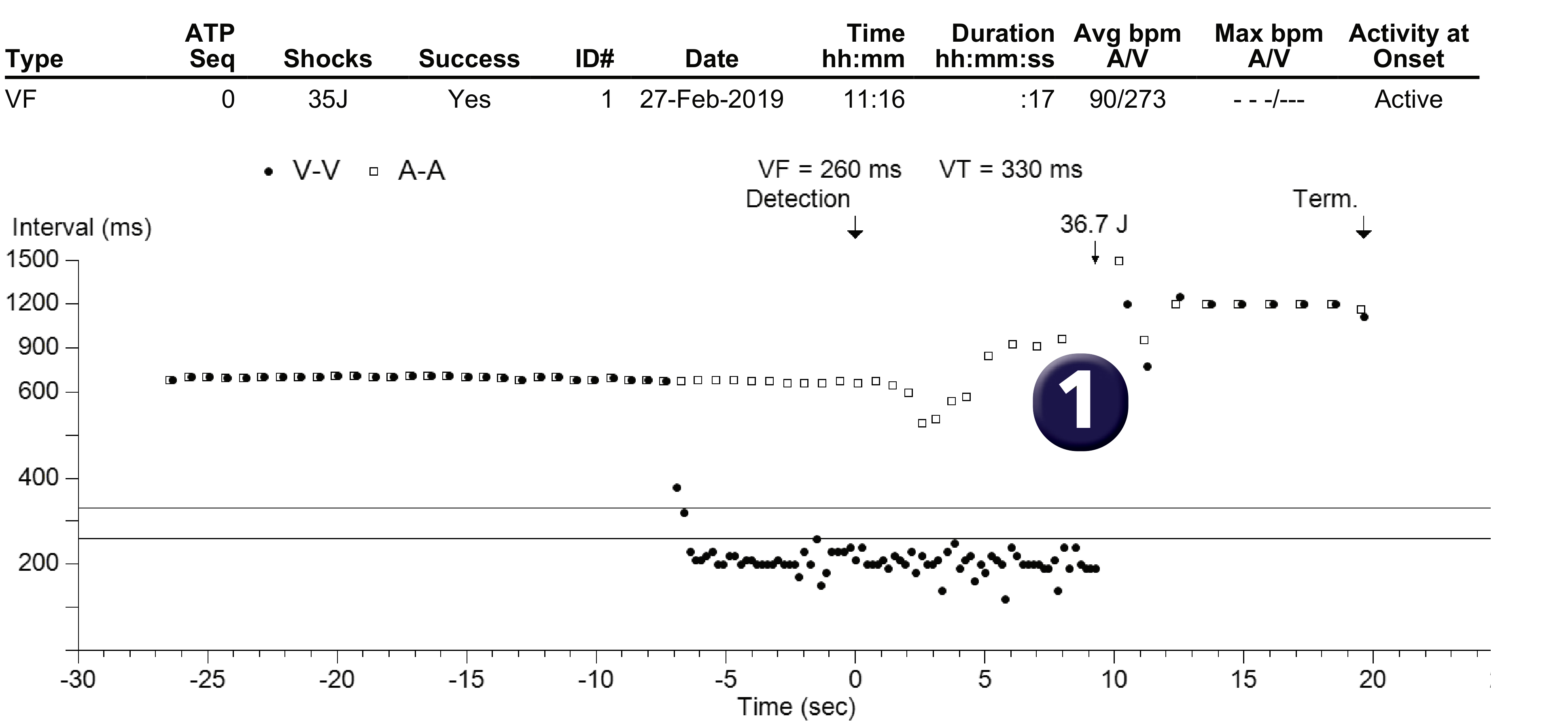 Medtronic ICD electrogram, segment 1 of 1 — A shock to restore a viable rhythm