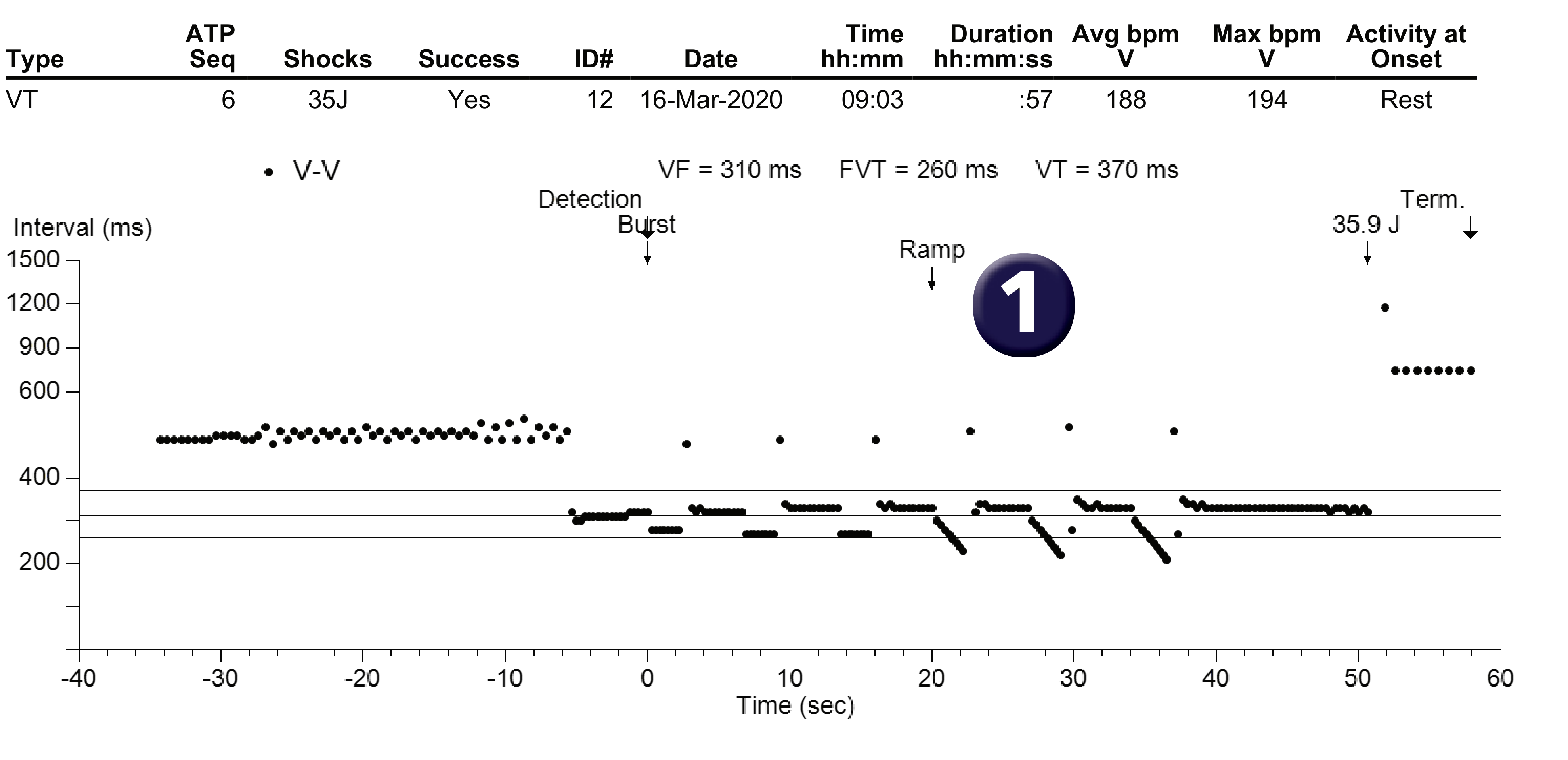 Medtronic ICD electrogram, segment 1 of 1 — Programming a first shock at maximum output in the VT zone