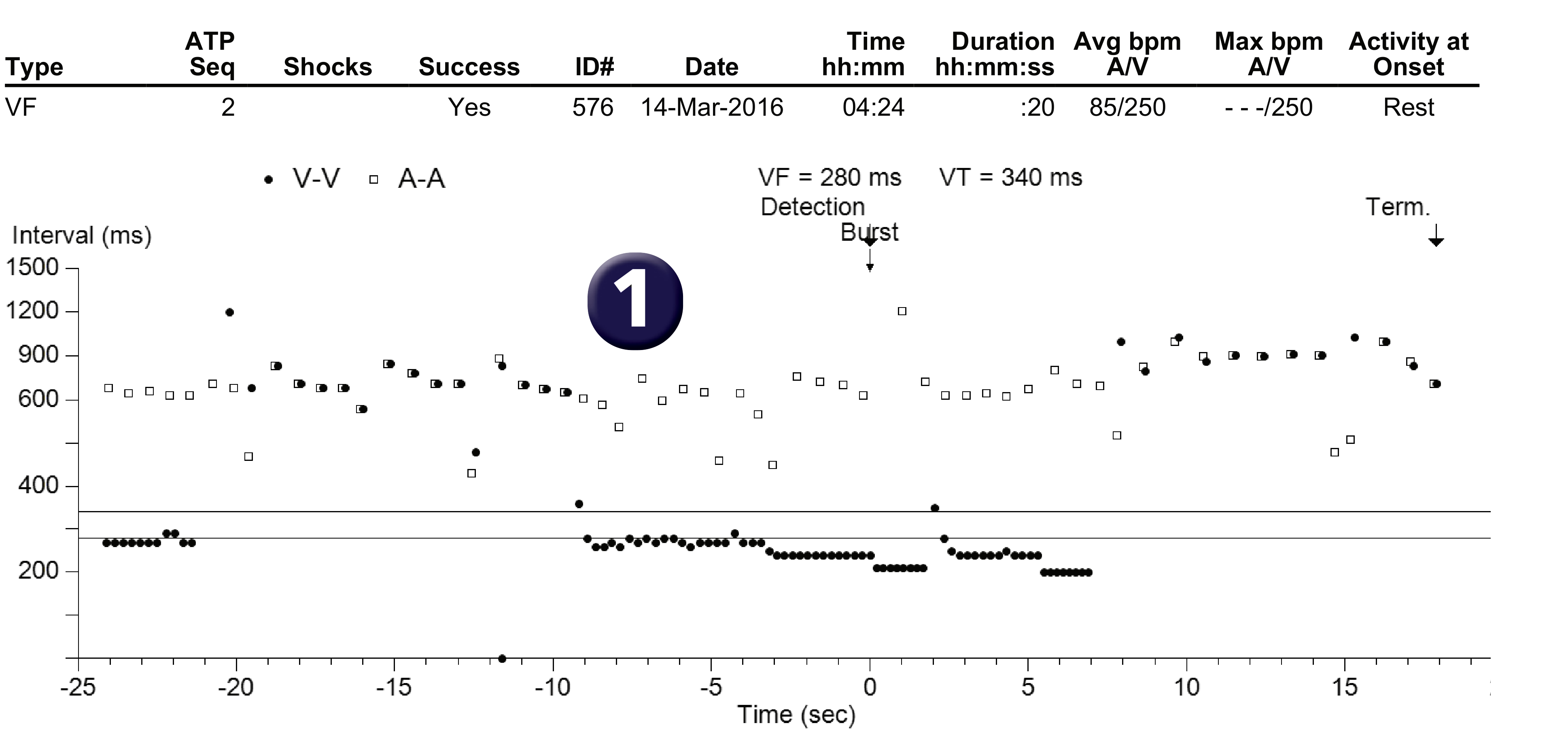 Medtronic ICD electrogram, segment 1 of 1 — Double anti-tachycardia pacing sequence